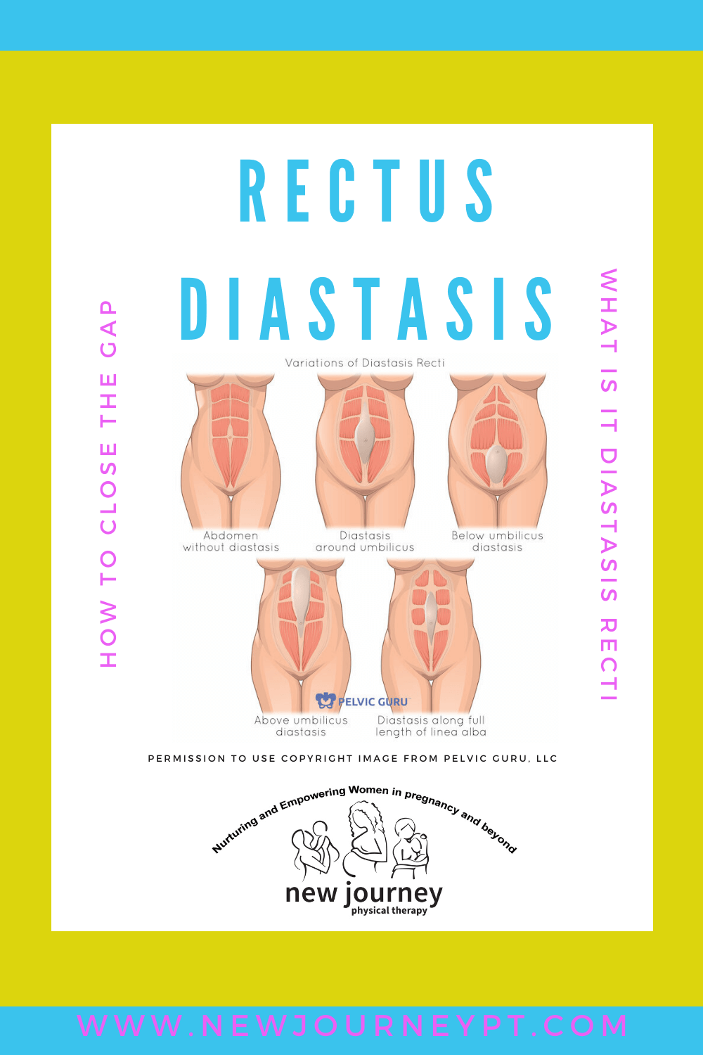 Transverse abdominis diastasis recti hotsell