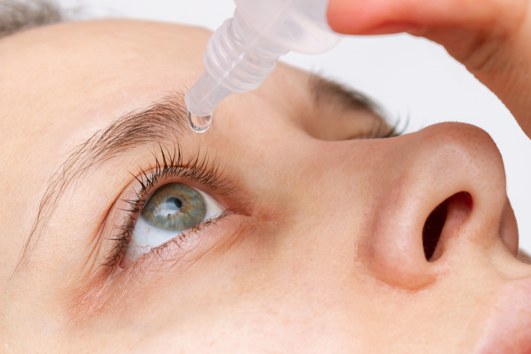 Woman using lubricating eye drops for dry eye syndrome relief as part of a daily eye care routine.