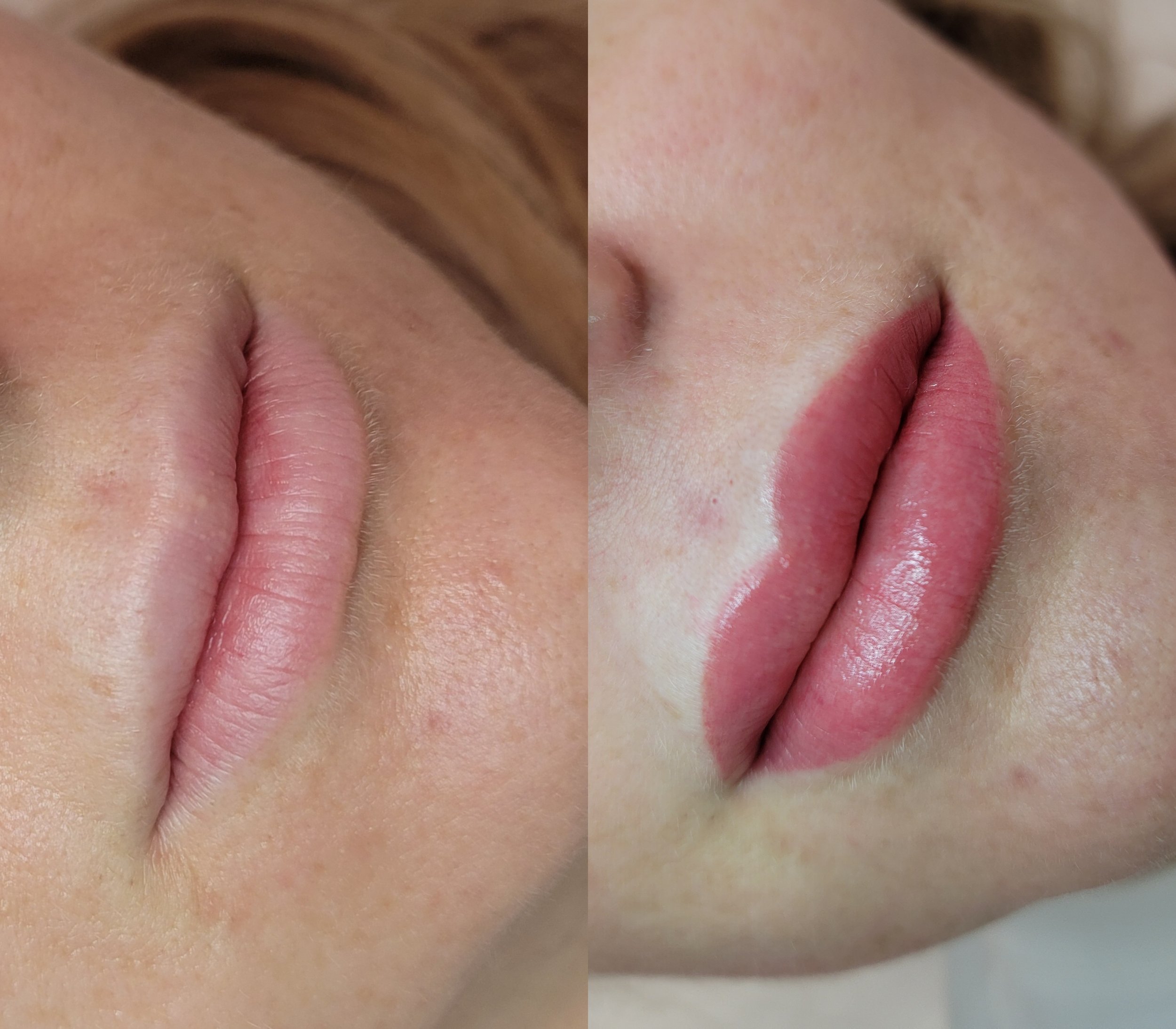 lip blush filler hyaluronic acid pale lips