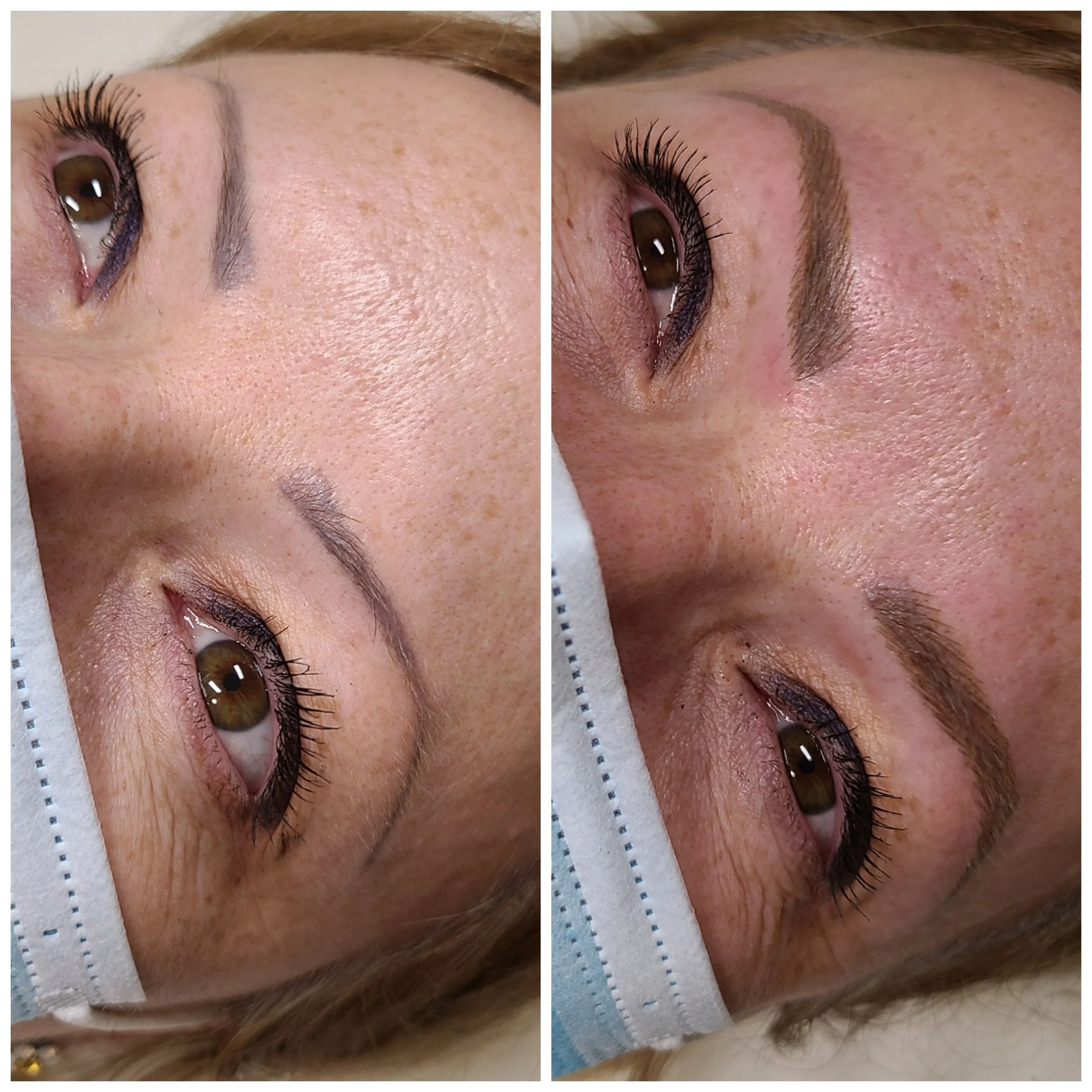 client tears before and after tattoo removal pico laser naples