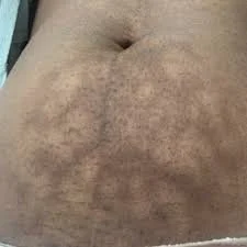 Is Your Heating Pad the Culprit of Your Hyperpigmentation?