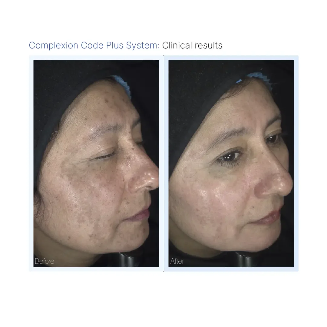 The Code Peel for Hperpigmentation and Melasma