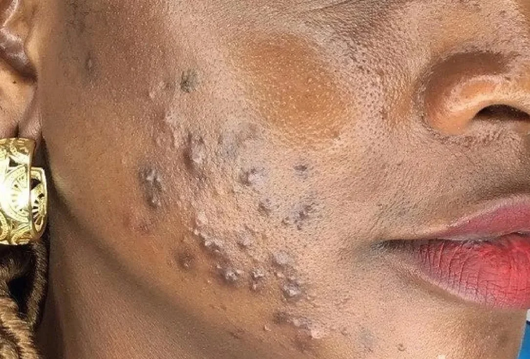 aerolase before and after.jpg