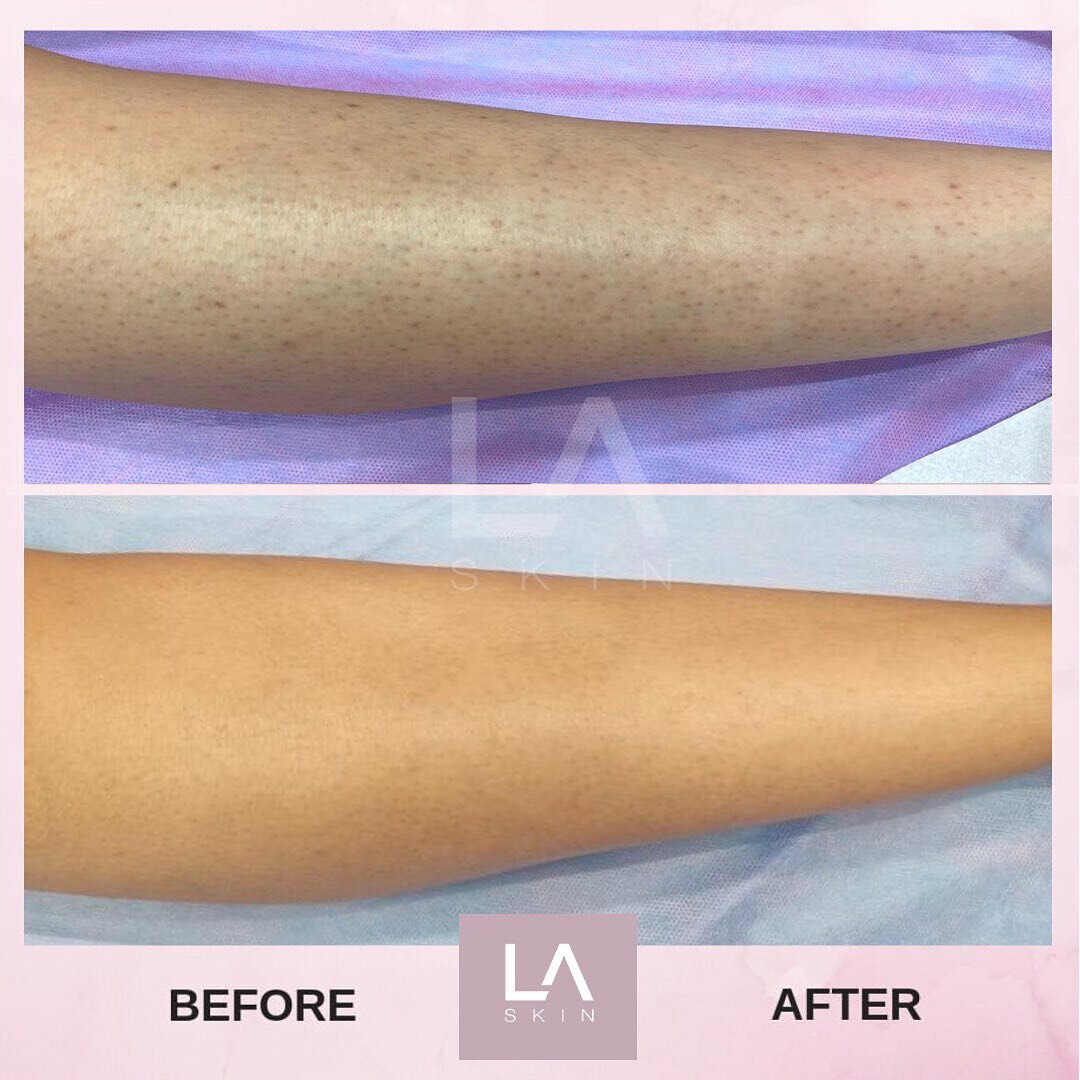 Laser can help with&hellip;
- Strawberry dots 
- Ingrown hairs
- Shaving rash 

It is truly life changing - book your laser consultation today 

☎️ Call us 0121 514 8868
📱WhatsApp 07481 102 872 
💌 enquiries@la-skin.co.uk 

*Laser results vary per i