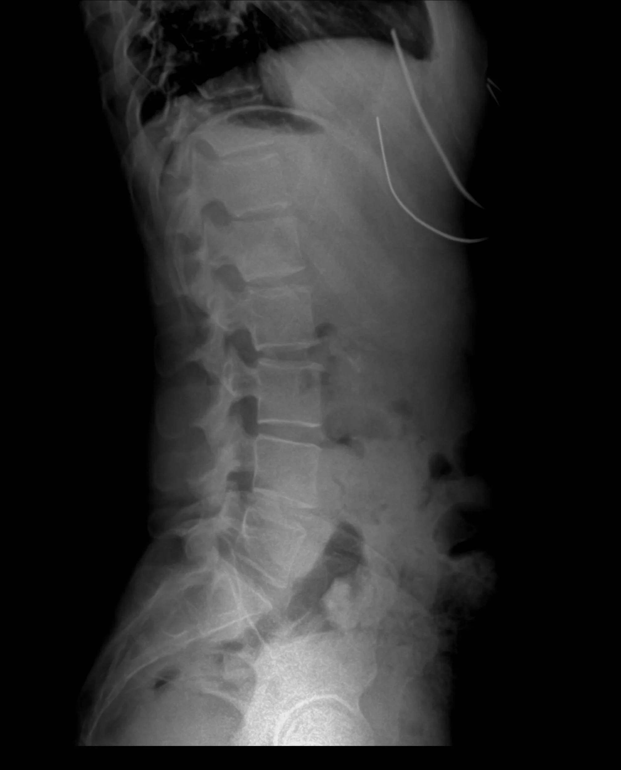 Spinal Cord injury