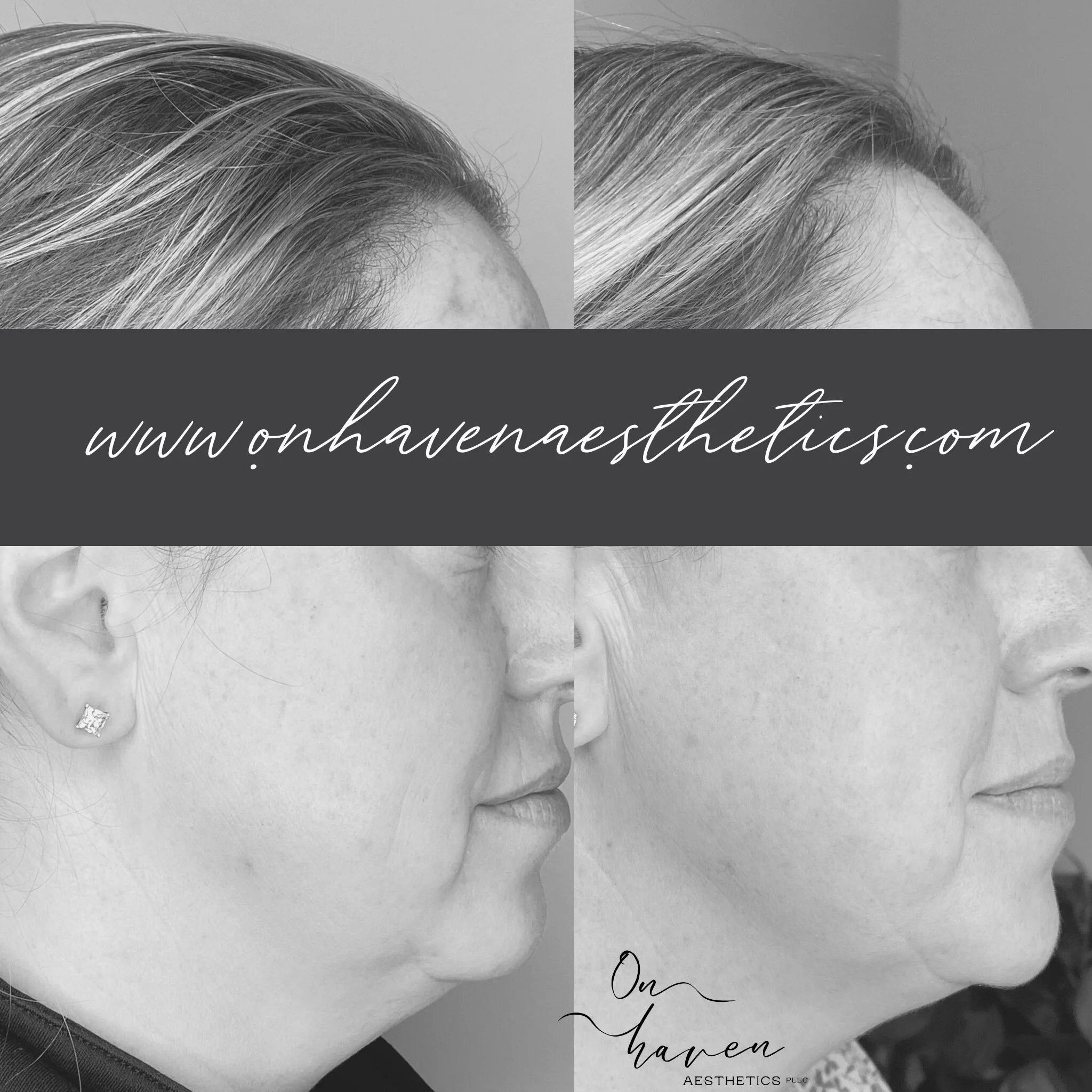 Kybella Treatment for Double Chin | On Haven Aesthetics