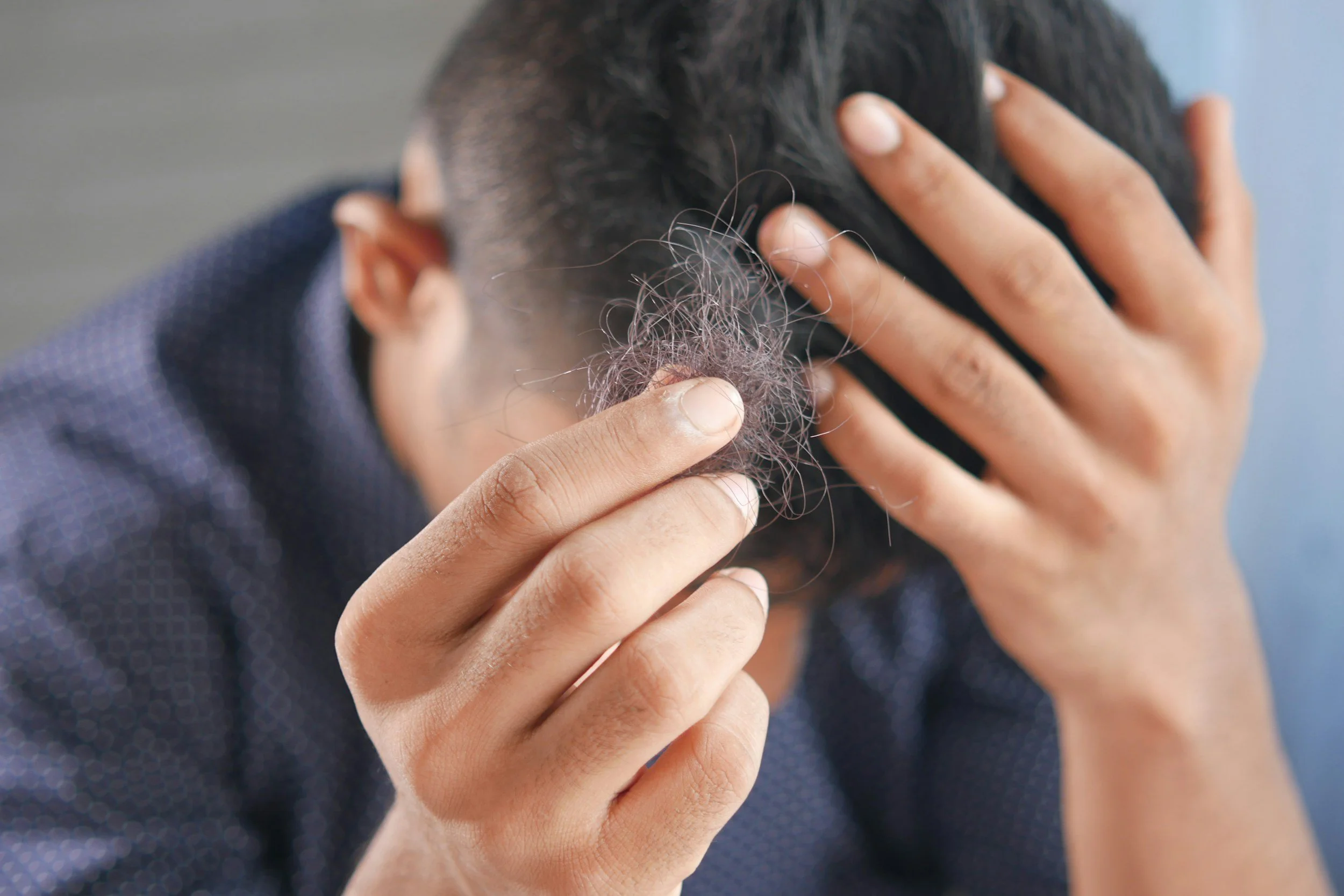 Hair loss drug under review for possible mental health side effects