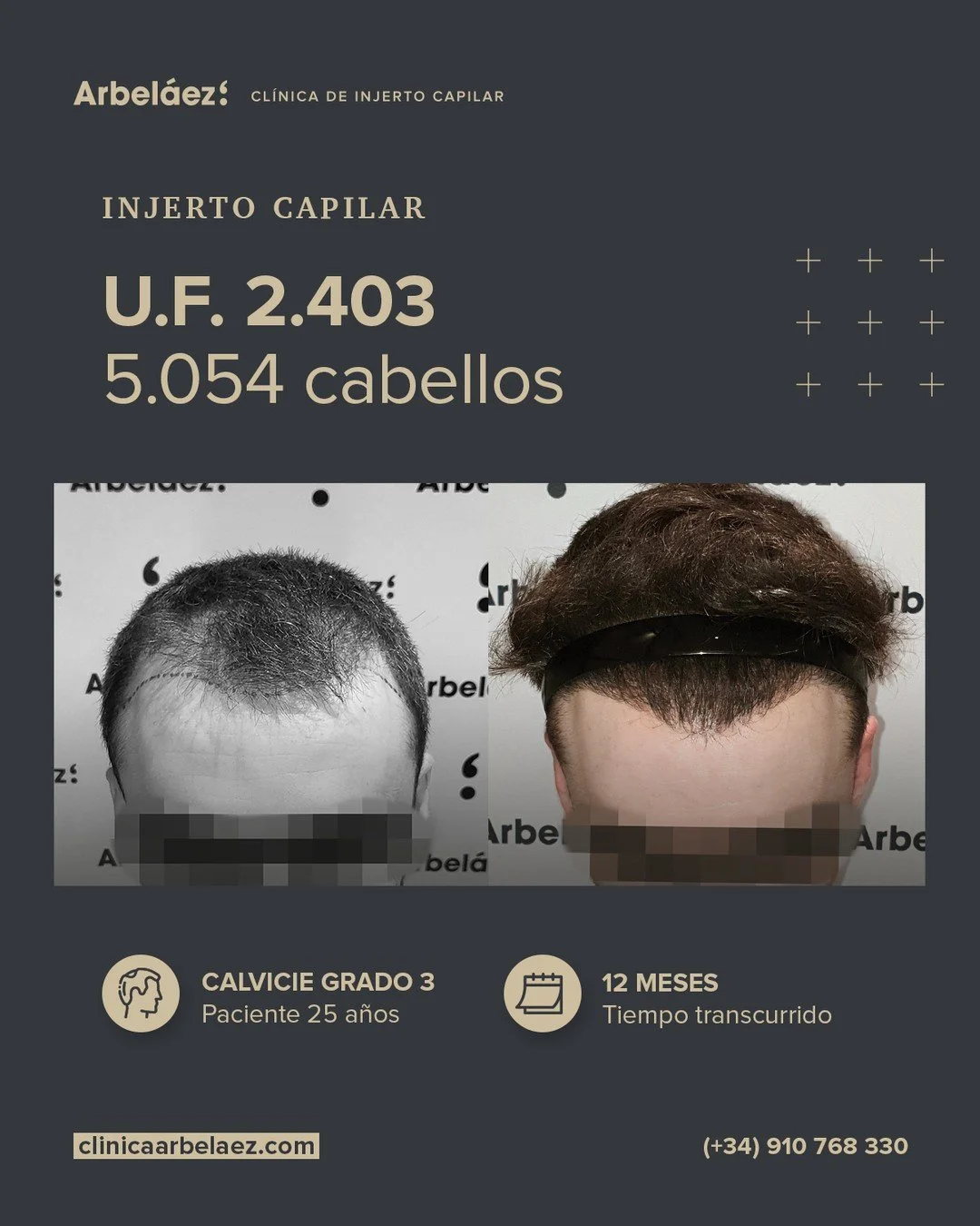 🏆𝘼𝙣𝙩𝙚𝙨 𝙮 𝙙𝙚𝙨𝙥𝙪𝙚́𝙨. (12 meses)
Cirugía realizada con Implanters.
👉Cirug&iacute;a total - U.F. 2.403 - 5.054 cabello

Reconstruir no solo el cabello, sino tambi&eacute;n la confianza
En este caso trabajamos la restauraci&oacute;n comple