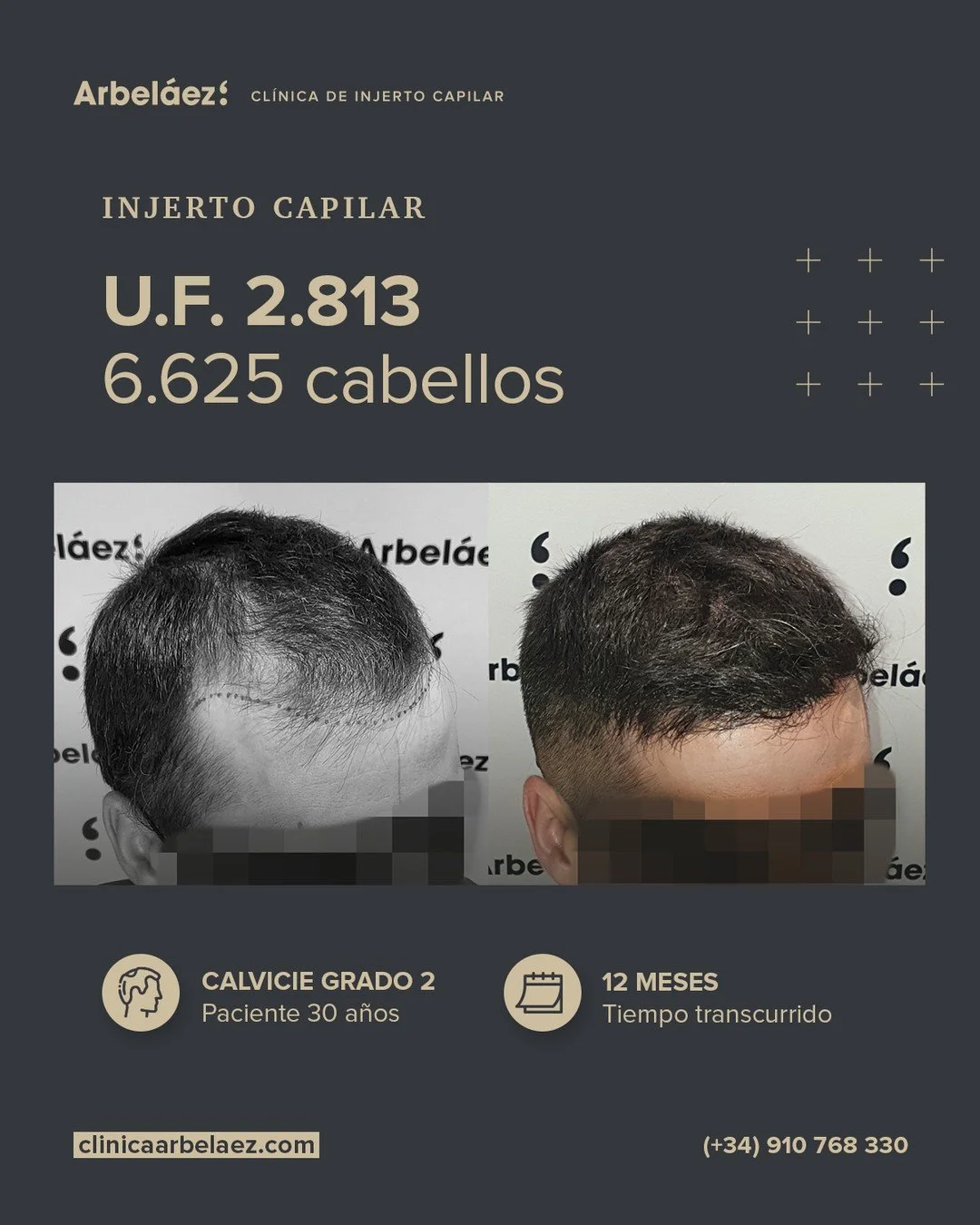 🏆𝘼𝙣𝙩𝙚𝙨 𝙮 𝙙𝙚𝙨𝙥𝙪𝙚́𝙨. (12 meses)
Cirugía realizada con Implanters.
👉Cirug&iacute;a total - U.F. 2.813 - 6.625 cabello

Naturalidad, precisi&oacute;n y armon&iacute;a: as&iacute; trabajamos cada l&iacute;nea frontal.
En este caso realizam