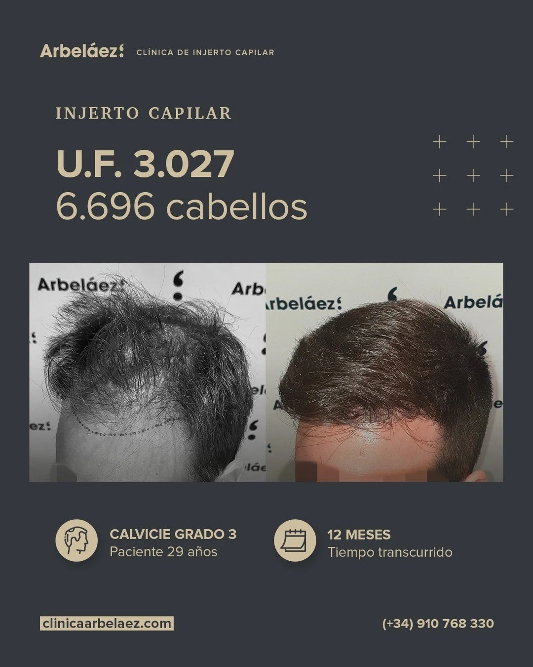 🏆𝘼𝙣𝙩𝙚𝙨 𝙮 𝙙𝙚𝙨𝙥𝙪𝙚́𝙨. (12 meses)
Cirugía realizada con Implanters.
👉Cirug&iacute;a total - U.F. 3.027 - 6.696 cabello

✅Naturalidad y equilibrio en una nueva l&iacute;nea frontal
En este caso, trabajamos una reconstrucci&oacute;n complet
