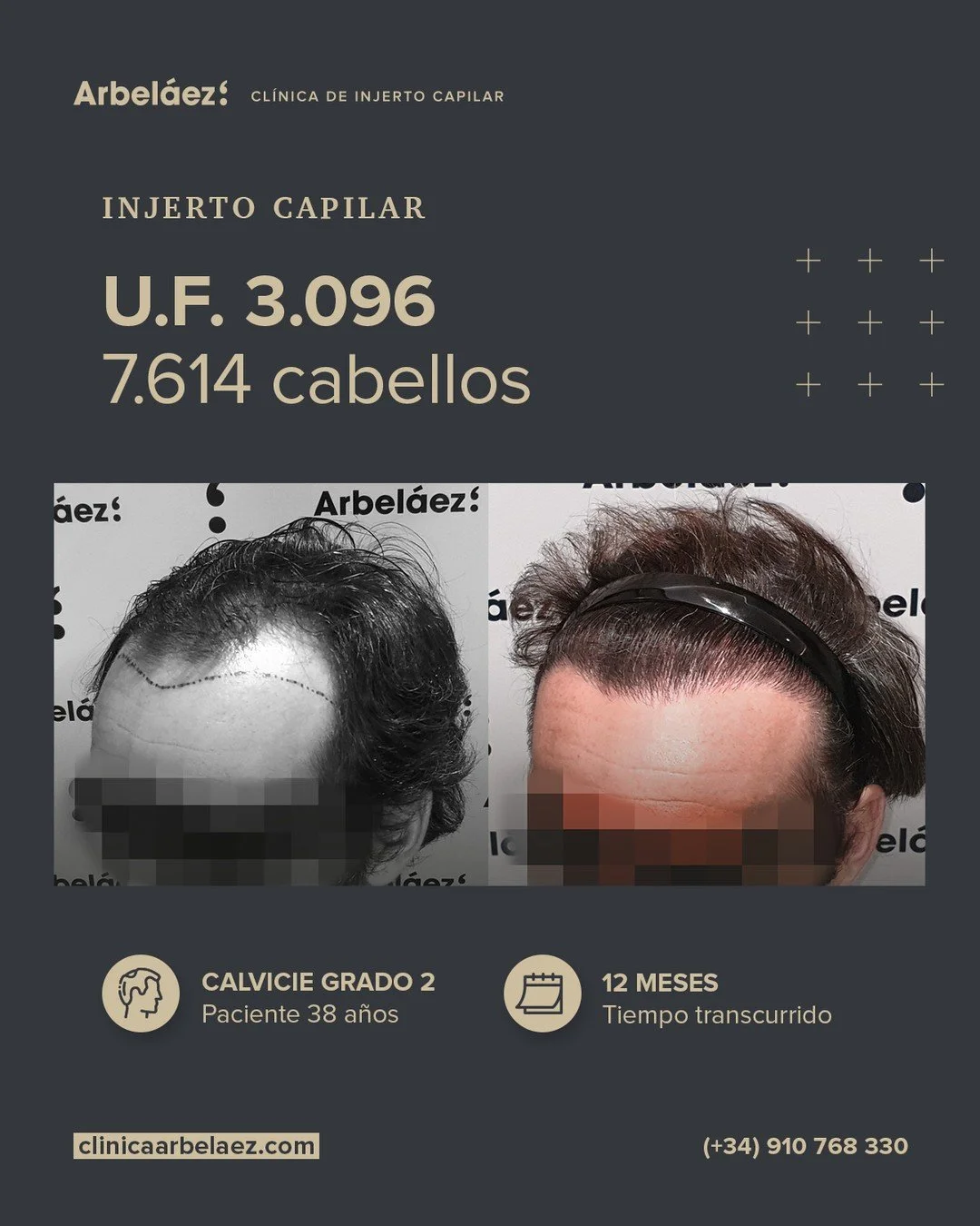 🏆𝘼𝙣𝙩𝙚𝙨 𝙮 𝙙𝙚𝙨𝙥𝙪𝙚́𝙨. (12 meses)
Cirugía realizada con Implanters.
👉Cirug&iacute;a total - U.F. 3.096 - 7.614 cabello

Dise&ntilde;o frontal: naturalidad que evoluciona con el tiempo.
En este caso realizamos una reconstrucci&oacute;n com