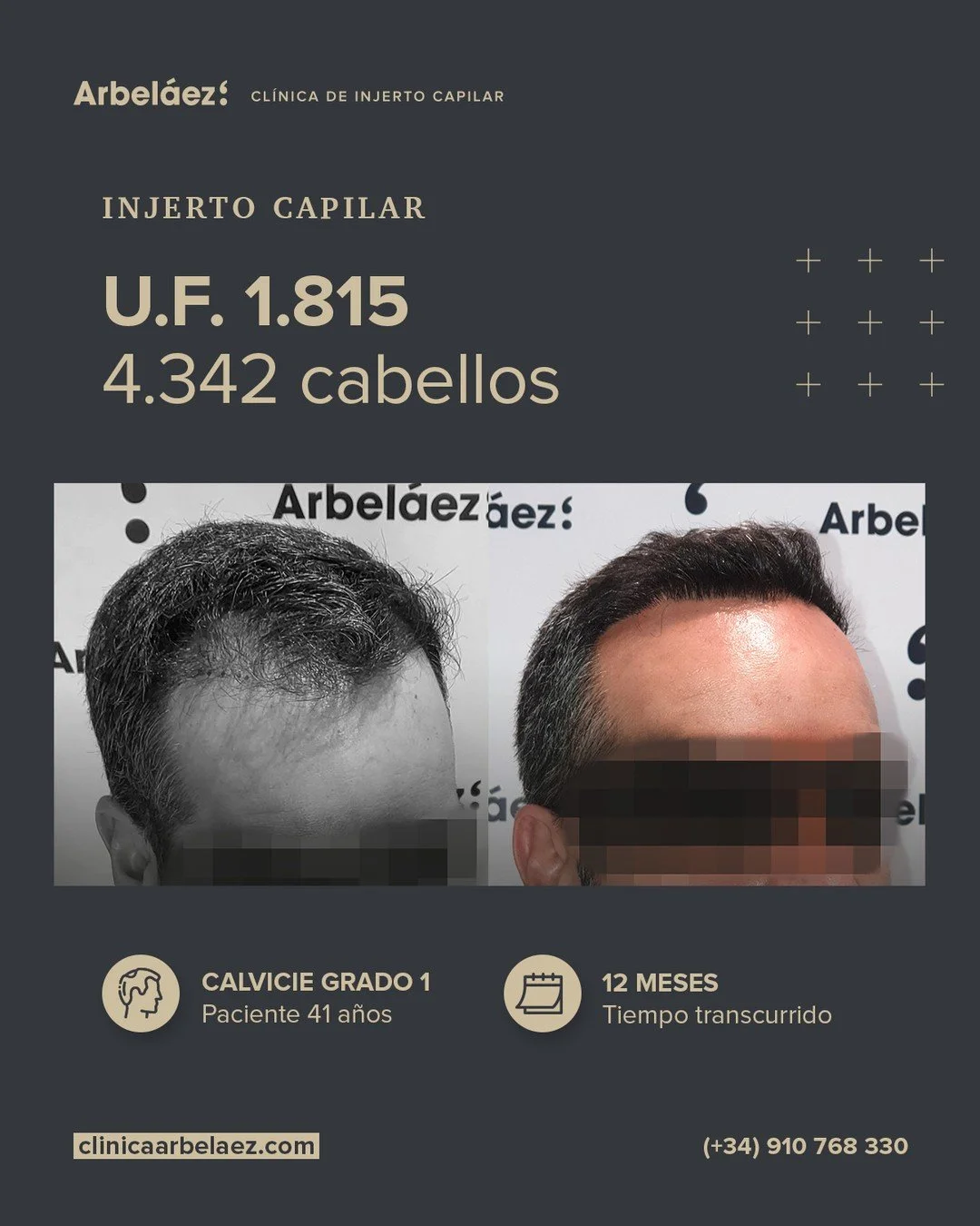 🏆𝘼𝙣𝙩𝙚𝙨 𝙮 𝙙𝙚𝙨𝙥𝙪𝙚́𝙨. (12 meses)
Cirugía realizada con Implanters.
👉Cirug&iacute;a total - U.F. 1.815 - 4.342 cabello

Antes y despu&eacute;s: una l&iacute;nea frontal natural y unas entradas reconstruidas
En este caso trabajamos la rest