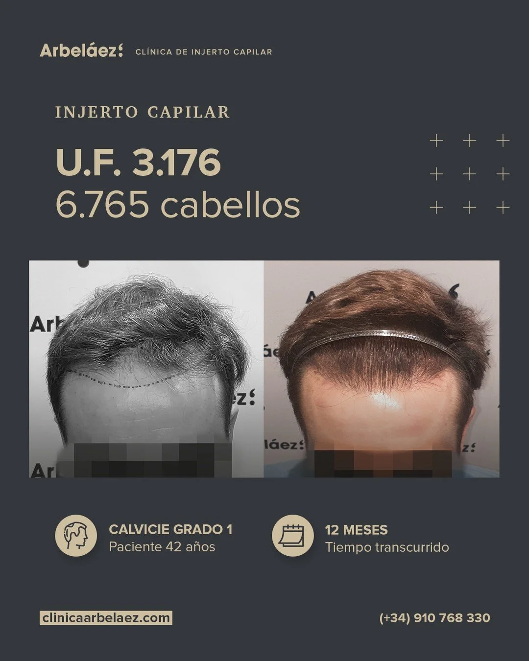 🏆𝘼𝙣𝙩𝙚𝙨 𝙮 𝙙𝙚𝙨𝙥𝙪𝙚́𝙨. (12 meses)
Cirugía realizada con Implanters.
👉Cirug&iacute;a total - U.F. 3.176 - 6.765 cabello

🔹 Cuando el dise&ntilde;o respeta al rostro, el resultado es natural
En este caso realizamos la creaci&oacute;n de un