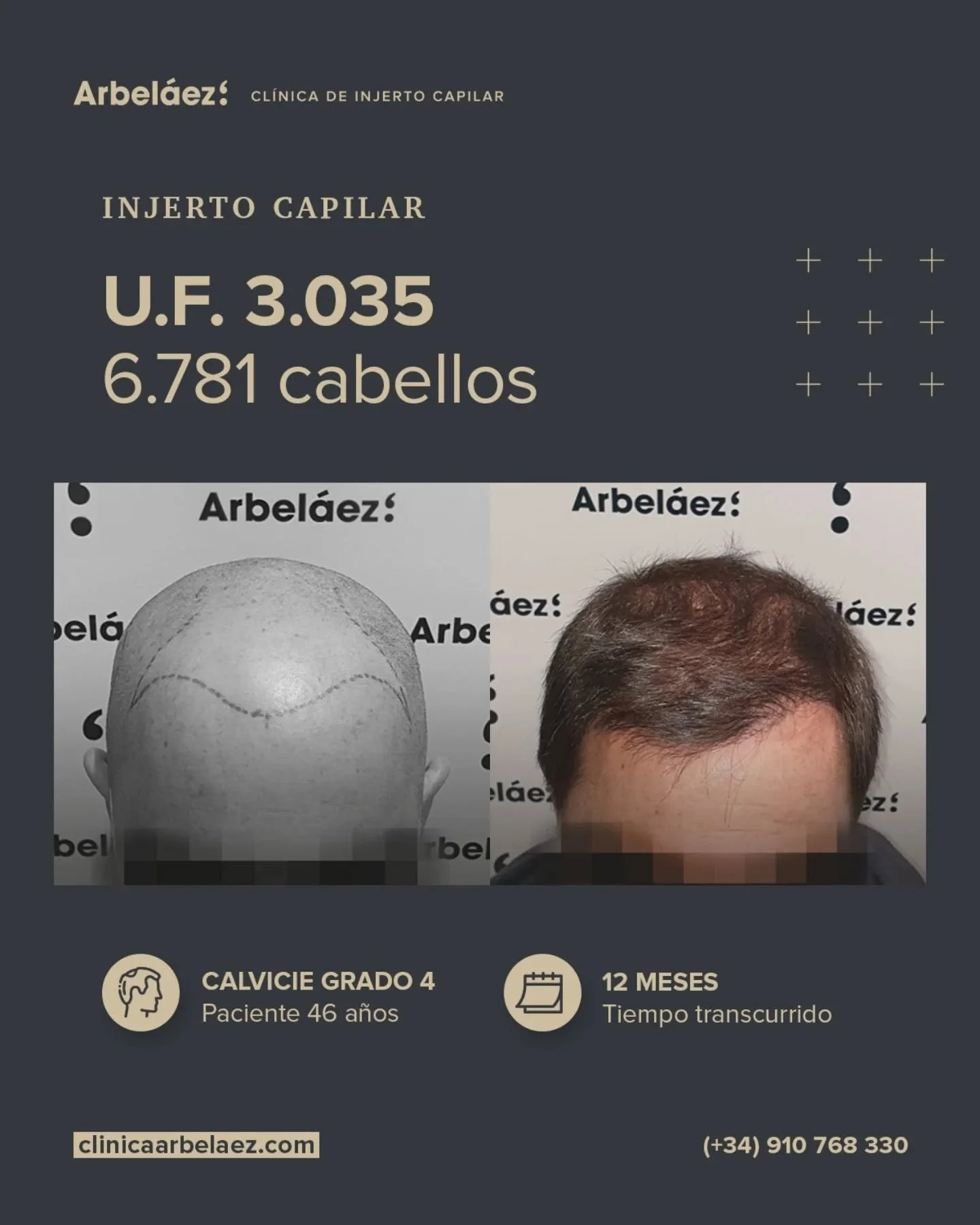 🏆𝘼𝙣𝙩𝙚𝙨 𝙮 𝙙𝙚𝙨𝙥𝙪𝙚́𝙨. (12 meses)
Cirugía realizada con Implanters.
👉Cirug&iacute;a total - U.F. 3.035 - 6.781 cabello

🔹 Antes y despu&eacute;s: una nueva l&iacute;nea frontal y el comienzo de la densidad

En este caso trabajamos la cre