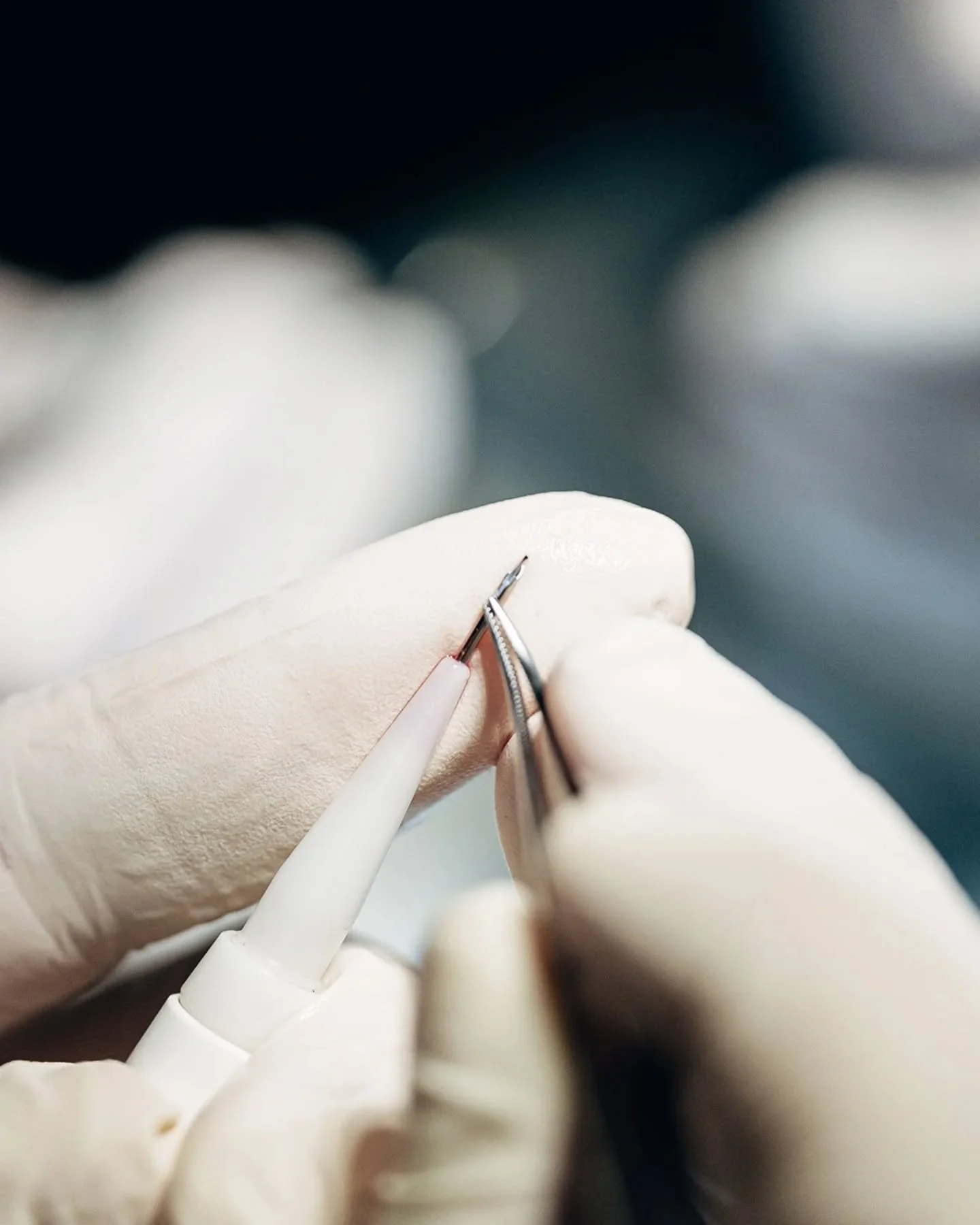 🔬 Precisi&oacute;n t&eacute;cnica en cada unidad folicular

En nuestros procedimientos con t&eacute;cnica FUE, cada detalle forma parte del resultado final.
El protocolo no es solo extracci&oacute;n e implantaci&oacute;n: es control absoluto en cada