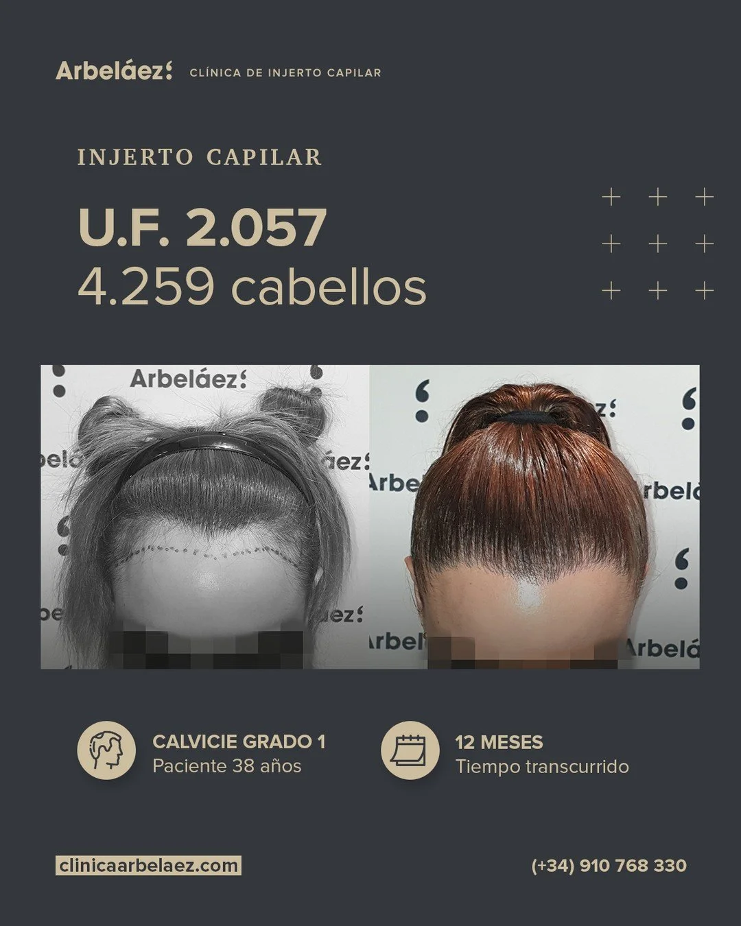 🏆𝘼𝙣𝙩𝙚𝙨 𝙮 𝙙𝙚𝙨𝙥𝙪𝙚́𝙨. (12 meses)
Cirugía realizada con Implanters.
👉Cirug&iacute;a total - U.F. 2.057 - 4.259 cabello

🔹 Antes y despu&eacute;s: una l&iacute;nea frontal femenina, natural y arm&oacute;nica
En este caso trabajamos el dis
