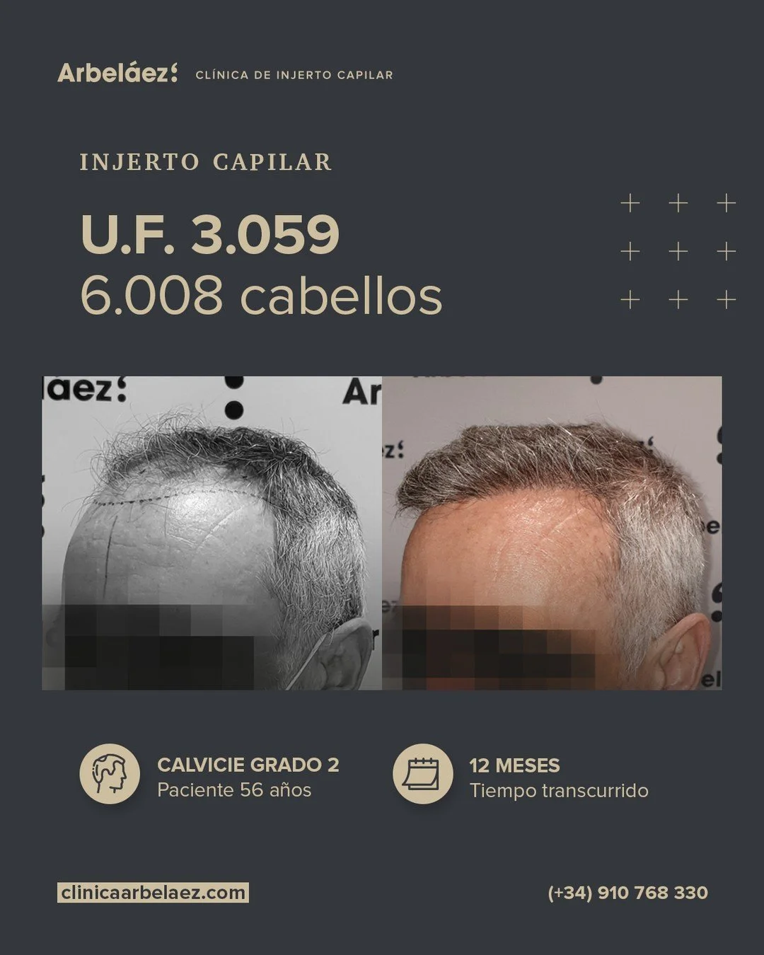 🔹 Antes y despu&eacute;s: una nueva l&iacute;nea frontal y m&aacute;s densidad a los 56 a&ntilde;os
En este caso trabajamos la creaci&oacute;n de una nueva l&iacute;nea frontal y la densificaci&oacute;n de la zona superior en un paciente de 56 a&nti