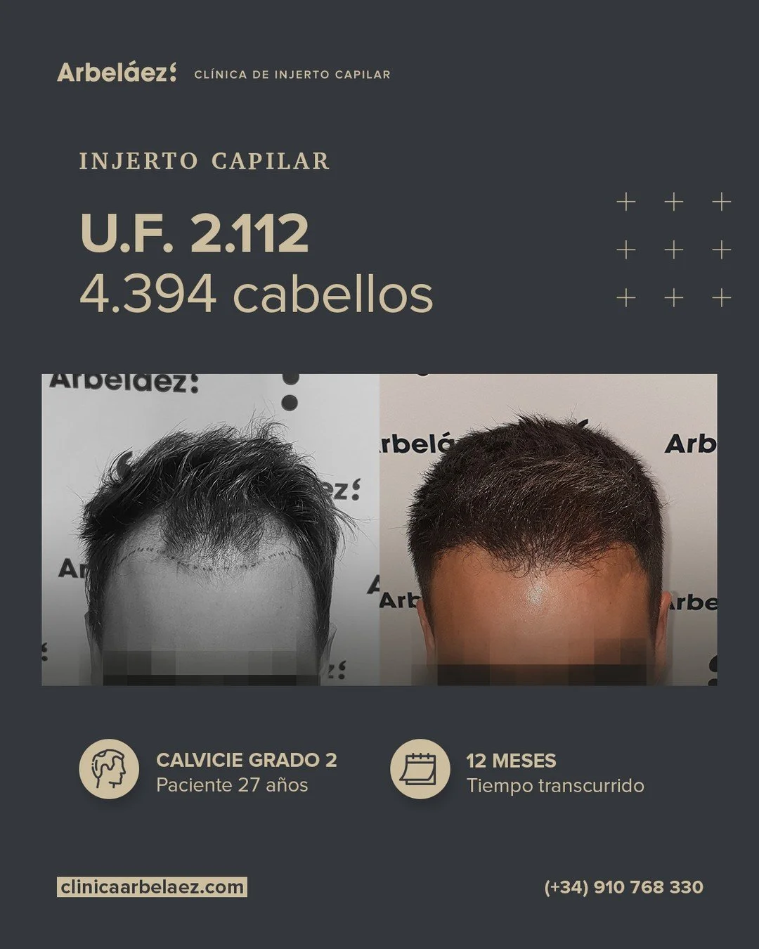 🏆𝘼𝙣𝙩𝙚𝙨 𝙮 𝙙𝙚𝙨𝙥𝙪𝙚́𝙨. (12 meses)
Cirugía realizada con Implanters.
👉Cirug&iacute;a total - U.F. 2.112 - 4.394 cabello

Una l&iacute;nea frontal natural y unas entradas integradas
En este caso realizamos el dise&ntilde;o de una nueva l&ia