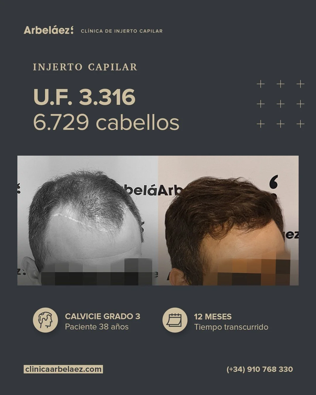 🏆𝘼𝙣𝙩𝙚𝙨 𝙮 𝙙𝙚𝙨𝙥𝙪𝙚́𝙨. (12 meses)
Cirugía realizada con Implanters.
👉Cirug&iacute;a total - U.F. 3.316 - 6.729 cabello

En este caso trabajamos el dise&ntilde;o de una nueva l&iacute;nea frontal junto con la densificaci&oacute;n de la zon