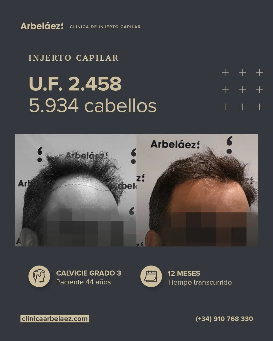 🏆𝘼𝙣𝙩𝙚𝙨 𝙮 𝙙𝙚𝙨𝙥𝙪𝙚́𝙨. (12 meses)
Cirugía realizada con Implanters.
👉Cirug&iacute;a total - U.F. 2.458 - 5.934 cabello

En este caso trabajamos la l&iacute;nea frontal reduciendo ligeramente la altura de la frente, pero manteniendo parte 