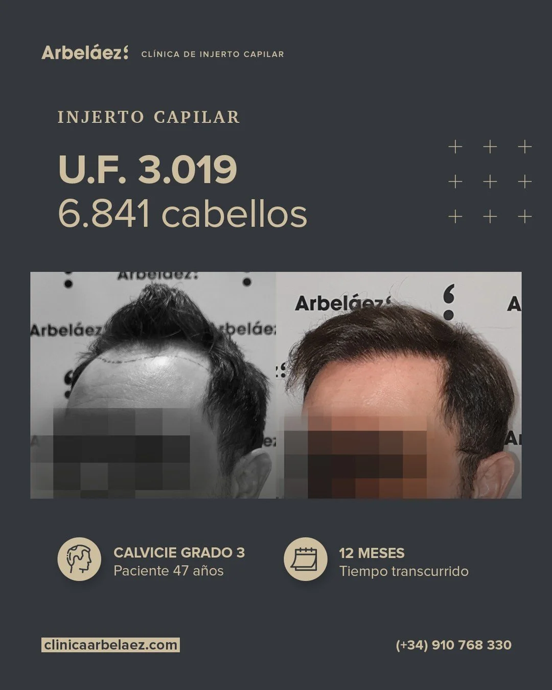 🏆𝘼𝙣𝙩𝙚𝙨 𝙮 𝙙𝙚𝙨𝙥𝙪𝙚́𝙨. (12 meses)
Cirugía realizada con Implanters.
👉Cirug&iacute;a total - U.F. 3.019 - 6.841 cabello

En este caso realizamos un redise&ntilde;o de la l&iacute;nea frontal reduciendo la altura de la frente, pero conserva