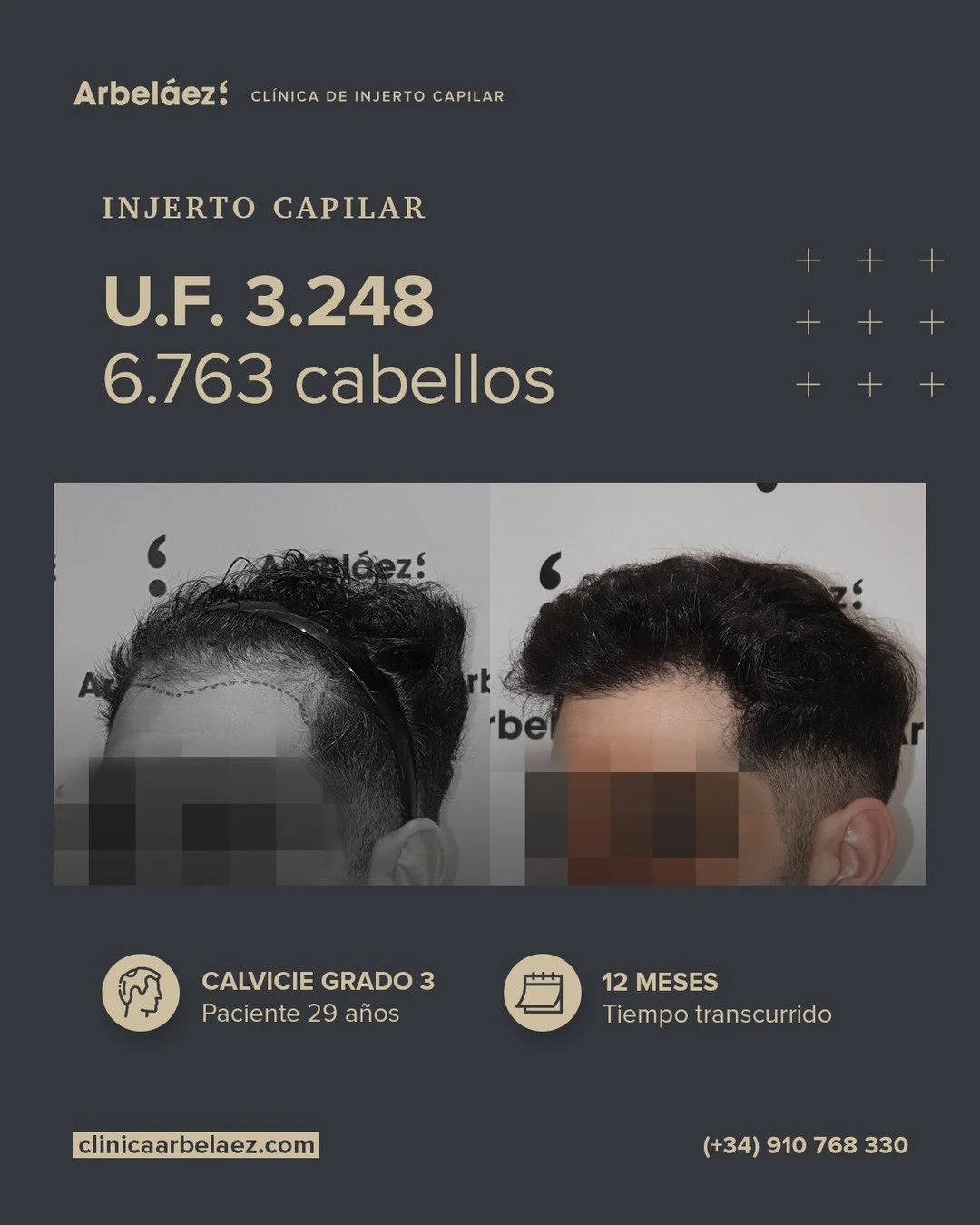 🏆𝘼𝙣𝙩𝙚𝙨 𝙮 𝙙𝙚𝙨𝙥𝙪𝙚́𝙨. (12 meses)
Cirugía realizada con Implanters.
👉Cirug&iacute;a total - U.F. 3.248 - 6.763 cabello

En este caso trabajamos el dise&ntilde;o de una nueva l&iacute;nea frontal en un paciente de 29 a&ntilde;os, reduciend