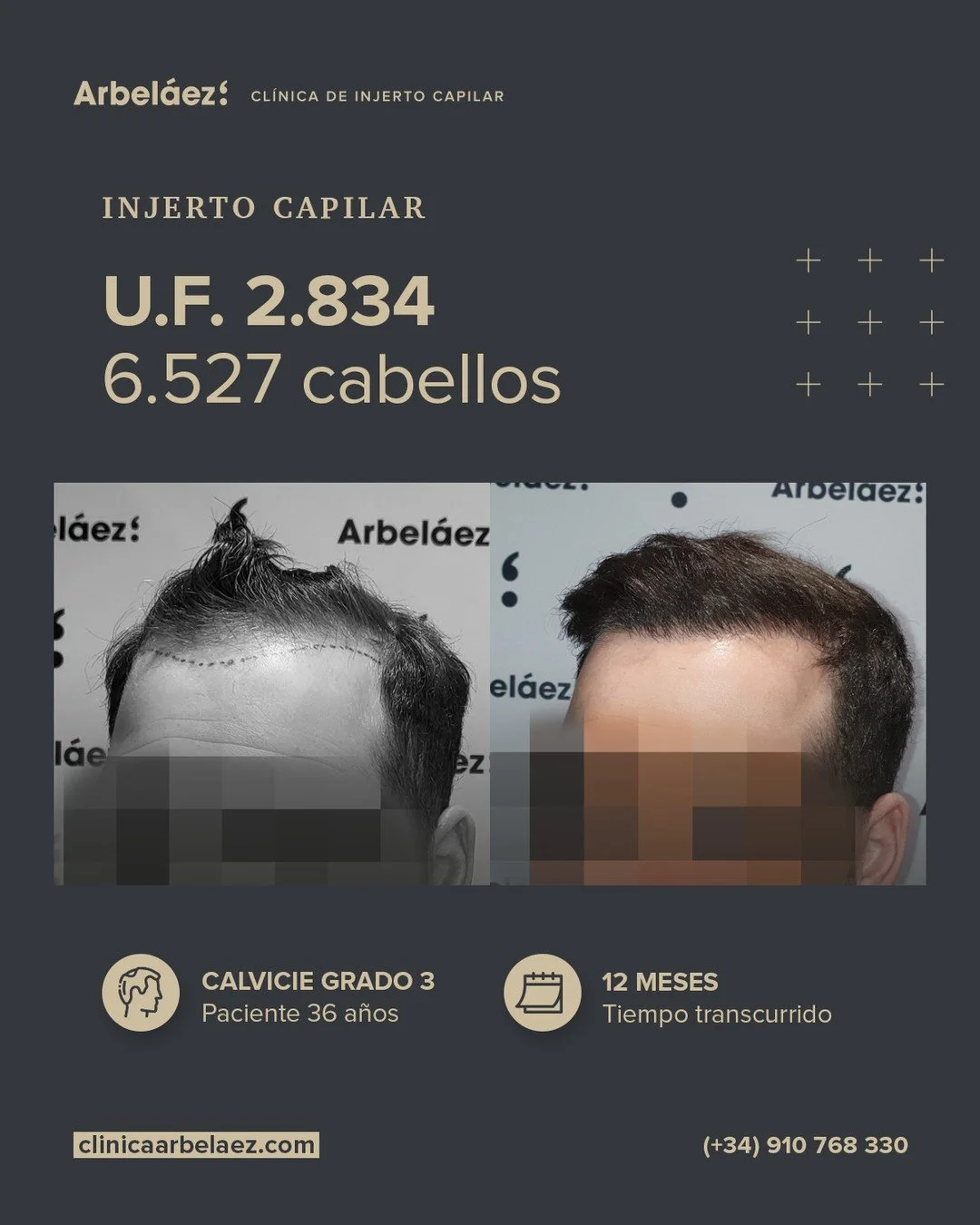 🏆𝘼𝙣𝙩𝙚𝙨 𝙮 𝙙𝙚𝙨𝙥𝙪𝙚́𝙨. (12 meses)
Cirugía realizada con Implanters.
👉Cirug&iacute;a total - U.F. 2.834 - 6.527 cabello

En este caso realizamos un descenso de la l&iacute;nea frontal, reduciendo la altura de la frente, pero manteniendo de
