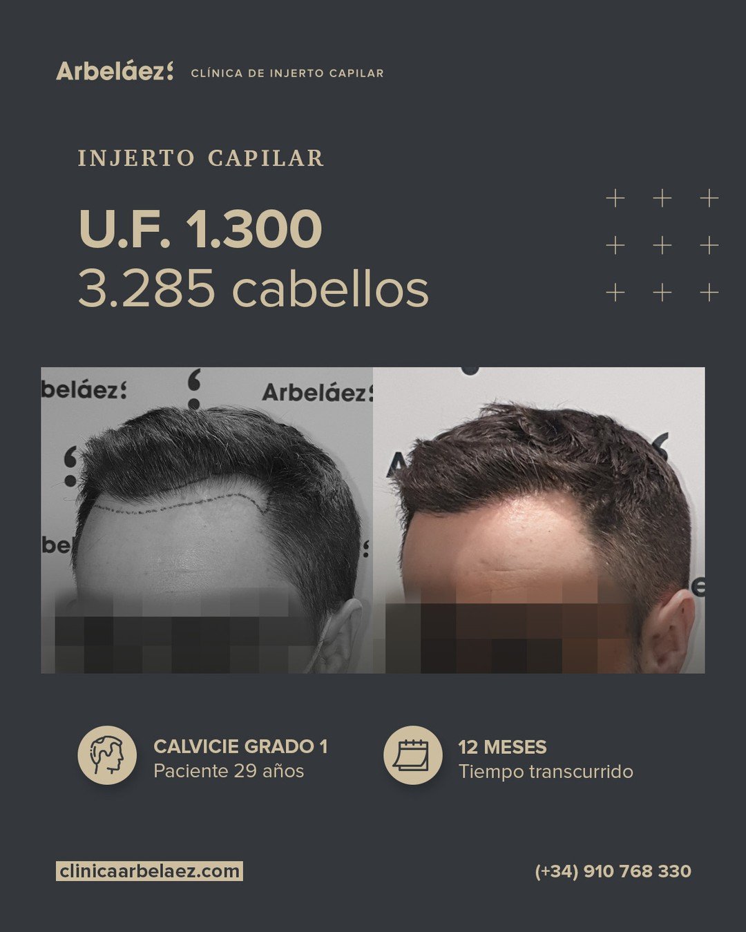 🏆𝘼𝙣𝙩𝙚𝙨 𝙮 𝙙𝙚𝙨𝙥𝙪𝙚́𝙨. (12 meses)
Cirugía realizada con Implanters.
👉Cirug&iacute;a total - U.F. 1.300 - 3.285 cabello

En este caso trabajamos una nueva l&iacute;nea frontal reduciendo la altura de la frente y suavizando las entradas, si
