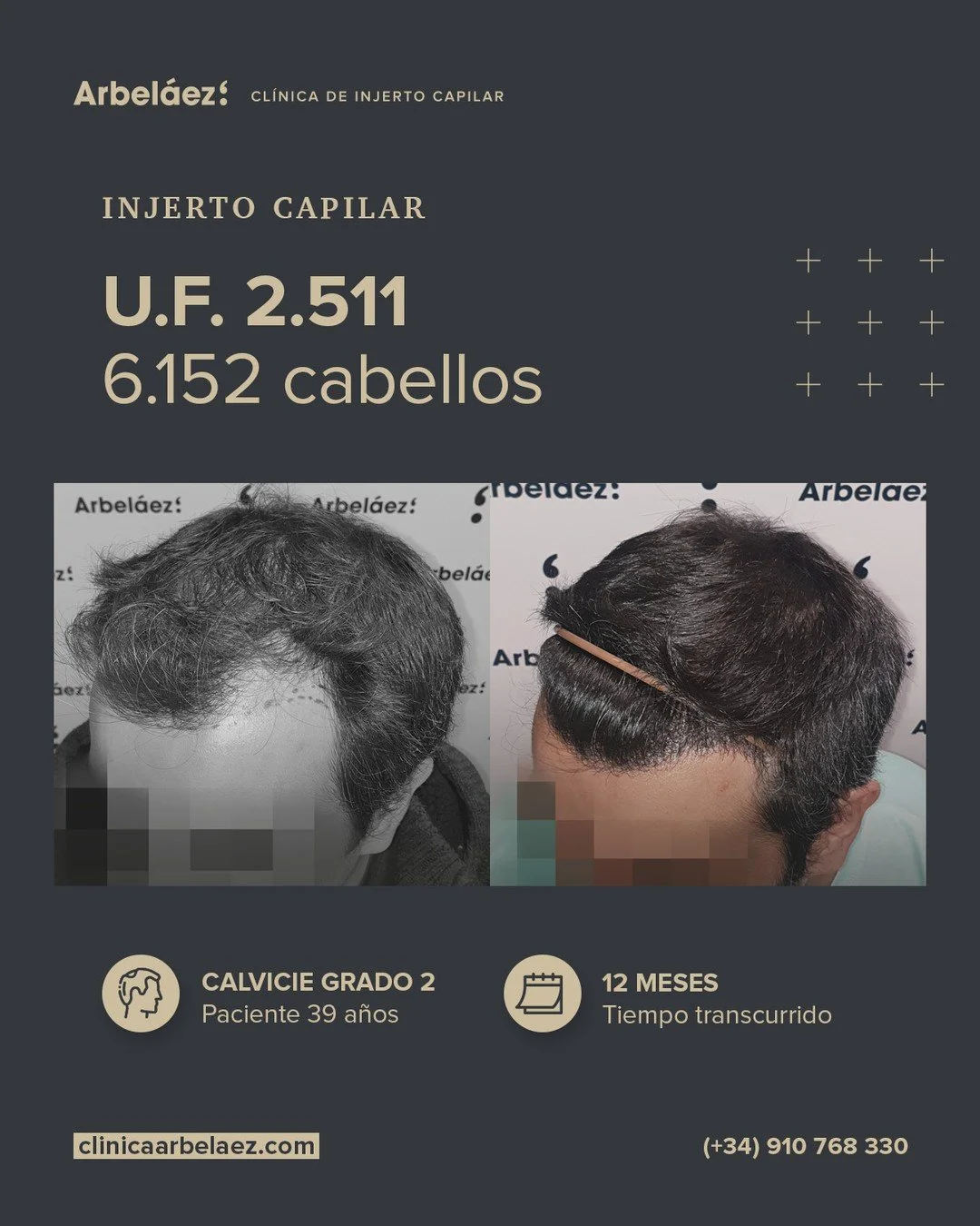 🏆𝘼𝙣𝙩𝙚𝙨 𝙮 𝙙𝙚𝙨𝙥𝙪𝙚́𝙨. (12 meses)
Cirugía realizada con Implanters.
👉Cirug&iacute;a total - U.F. 2.511 - 6.152 cabello

En este caso trabajamos la reconstrucci&oacute;n de las entradas buscando un resultado natural, equilibrado y adaptado