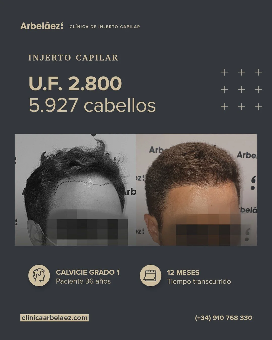 🏆𝘼𝙣𝙩𝙚𝙨 𝙮 𝙙𝙚𝙨𝙥𝙪𝙚́𝙨. (12 meses)
Cirugía realizada con Implanters.
👉Cirug&iacute;a total - U.F. 2.800 - 5.927 cabello

Cada l&iacute;nea frontal que dise&ntilde;amos tiene un objetivo: verse natural hoy, ma&ntilde;ana y dentro de muchos 