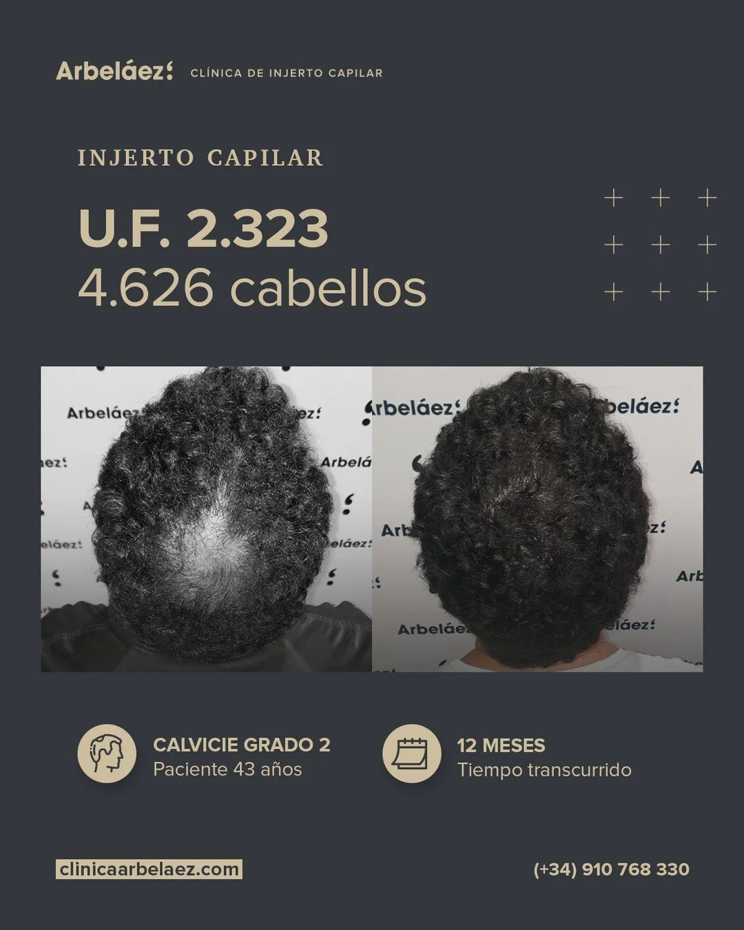 🏆𝘼𝙣𝙩𝙚𝙨 𝙮 𝙙𝙚𝙨𝙥𝙪𝙚́𝙨. (12 meses)
Cirugía realizada con Implanters.
👉Cirug&iacute;a total - U.F. 2.323 - 4.626 cabello

La coronilla es una de las zonas que requiere una planificaci&oacute;n especialmente cuidadosa en cirug&iacute;a capil