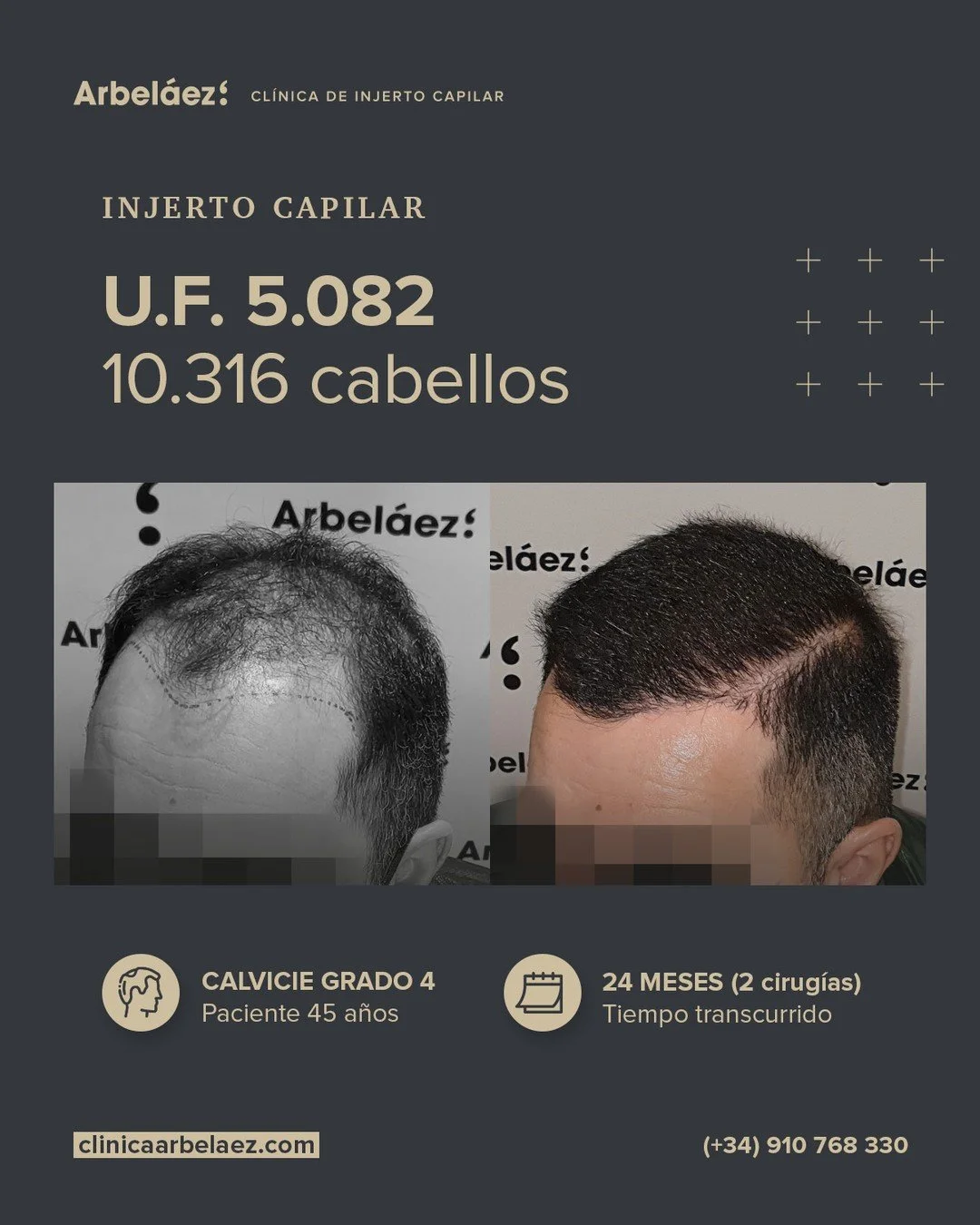 🏆𝘼𝙣𝙩𝙚𝙨 𝙮 𝙙𝙚𝙨𝙥𝙪𝙚́𝙨. (24 meses meses - 2 cirug&iacute;as)
Cirugía realizada con Implanters.
👉Cirug&iacute;a total - U.F. 5.082 - 10.316 cabello

En este caso part&iacute;amos de una p&eacute;rdida de densidad muy marcada en pr&aacute;ct