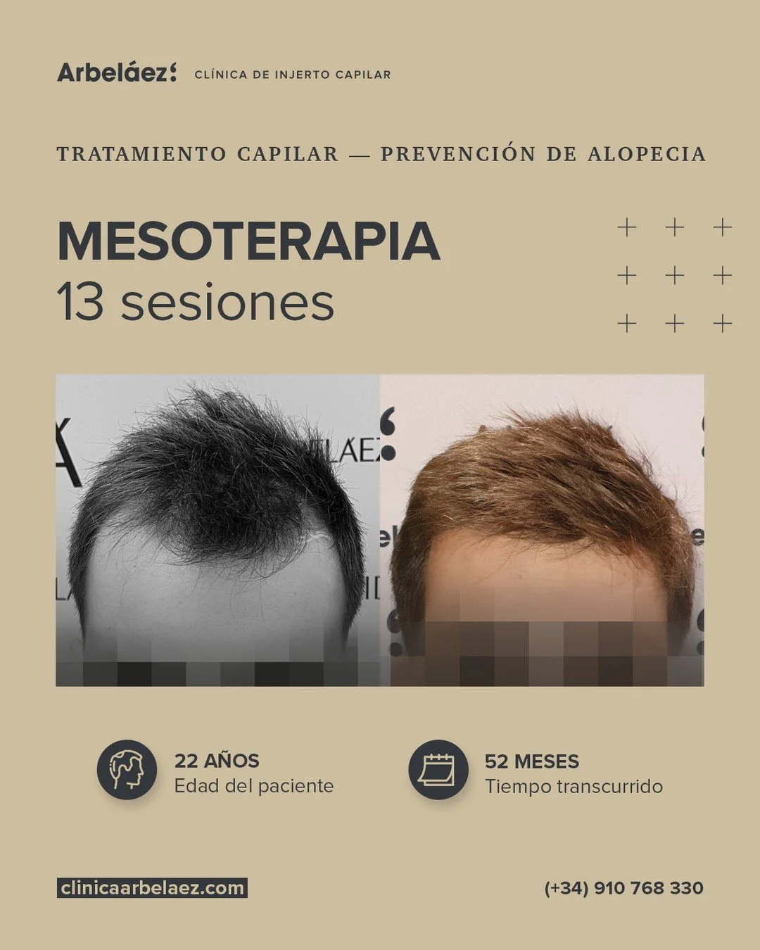 🏆𝘼𝙣𝙩𝙚𝙨 𝙮 𝙙𝙚𝙨𝙥𝙪𝙚́𝙨. (52 meses)
Tratamiento capilar para la prevenci&oacute;n de la alopecia
👉Mesoterapia -13 sesiones

En este caso presentamos la evoluci&oacute;n de un paciente de 22 a&ntilde;os tratado mediante mesoterapia capilar, c
