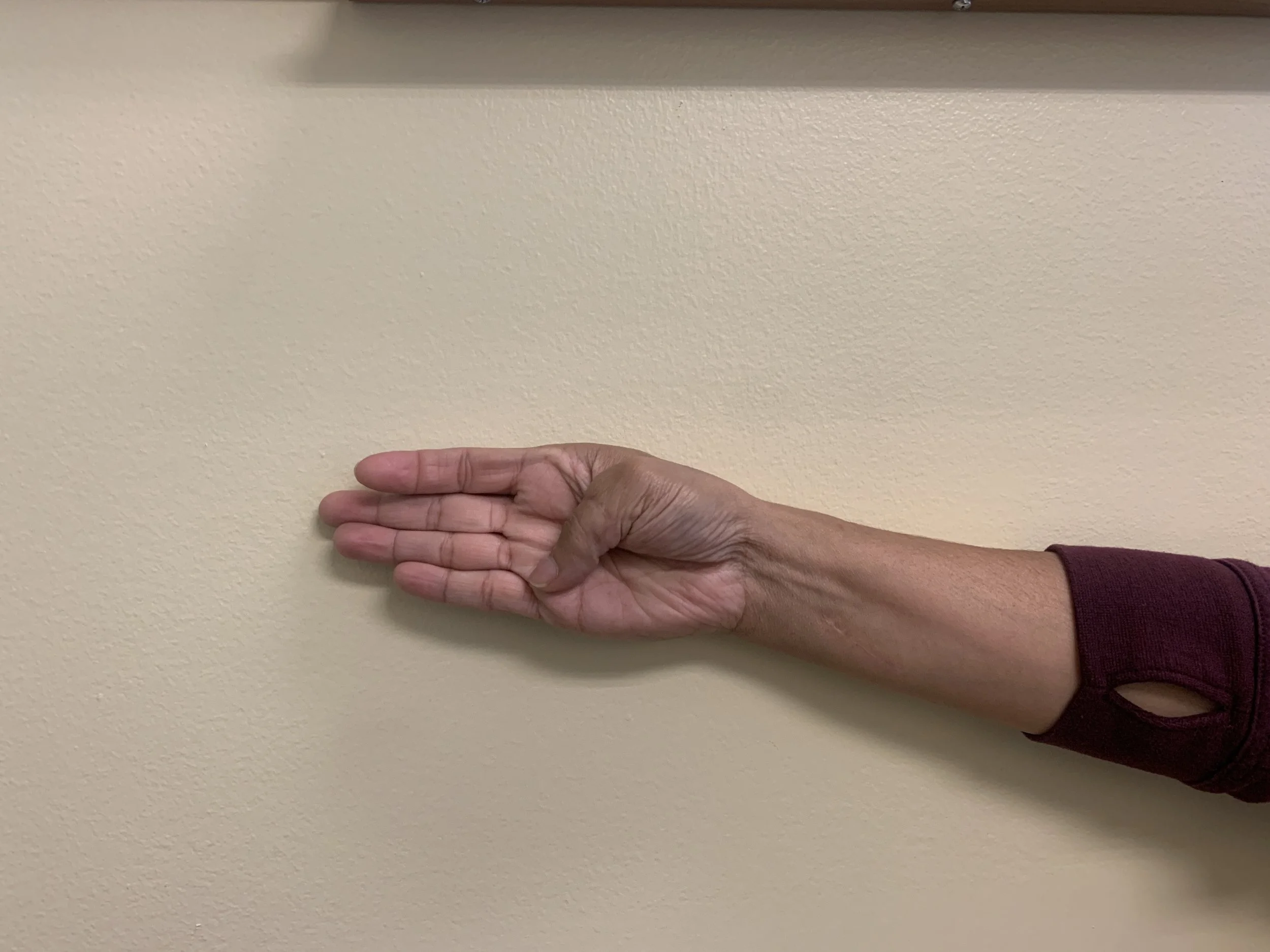 Thumb Replant Follow-Up 2.JPG