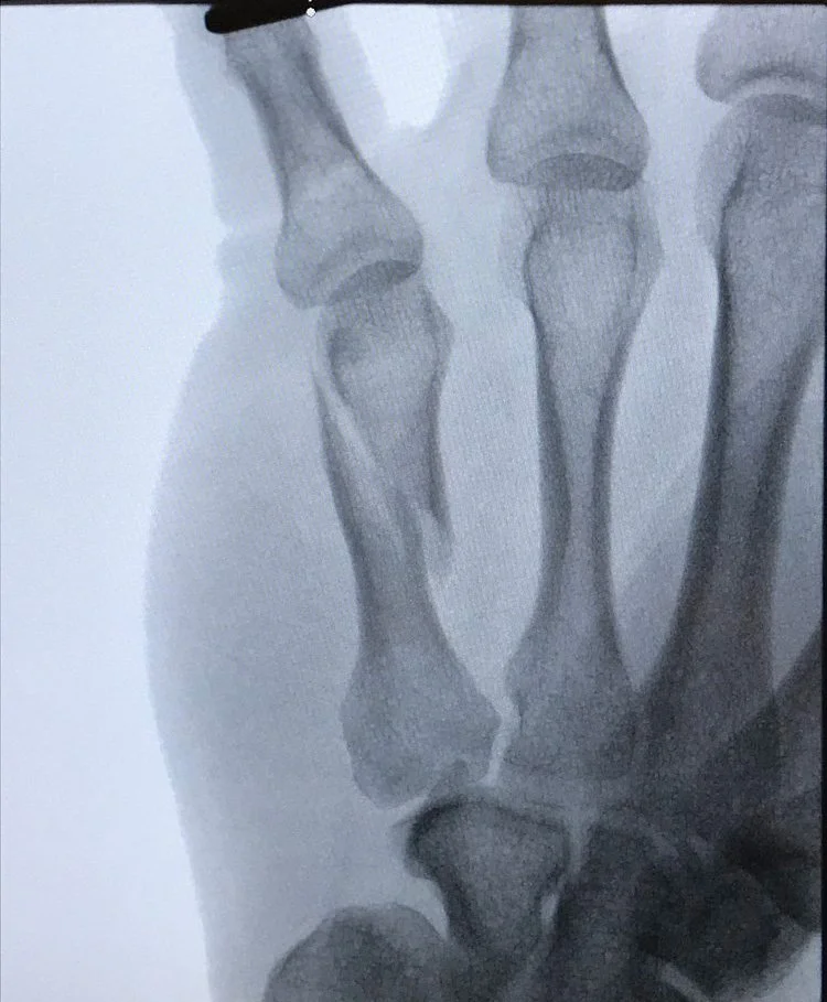 Spiral oblique metacarpal fracture
