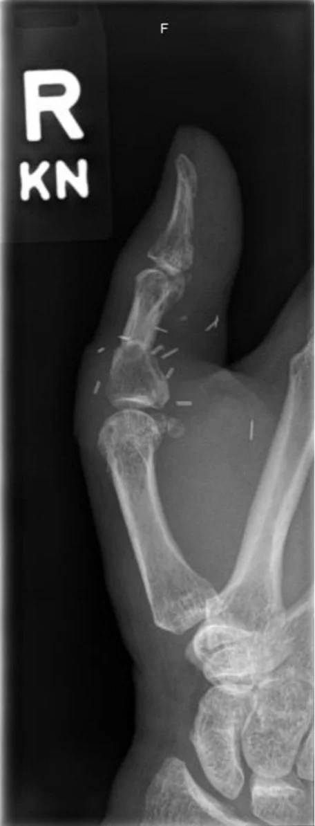 Thumb Replant X-ray 2.jpg