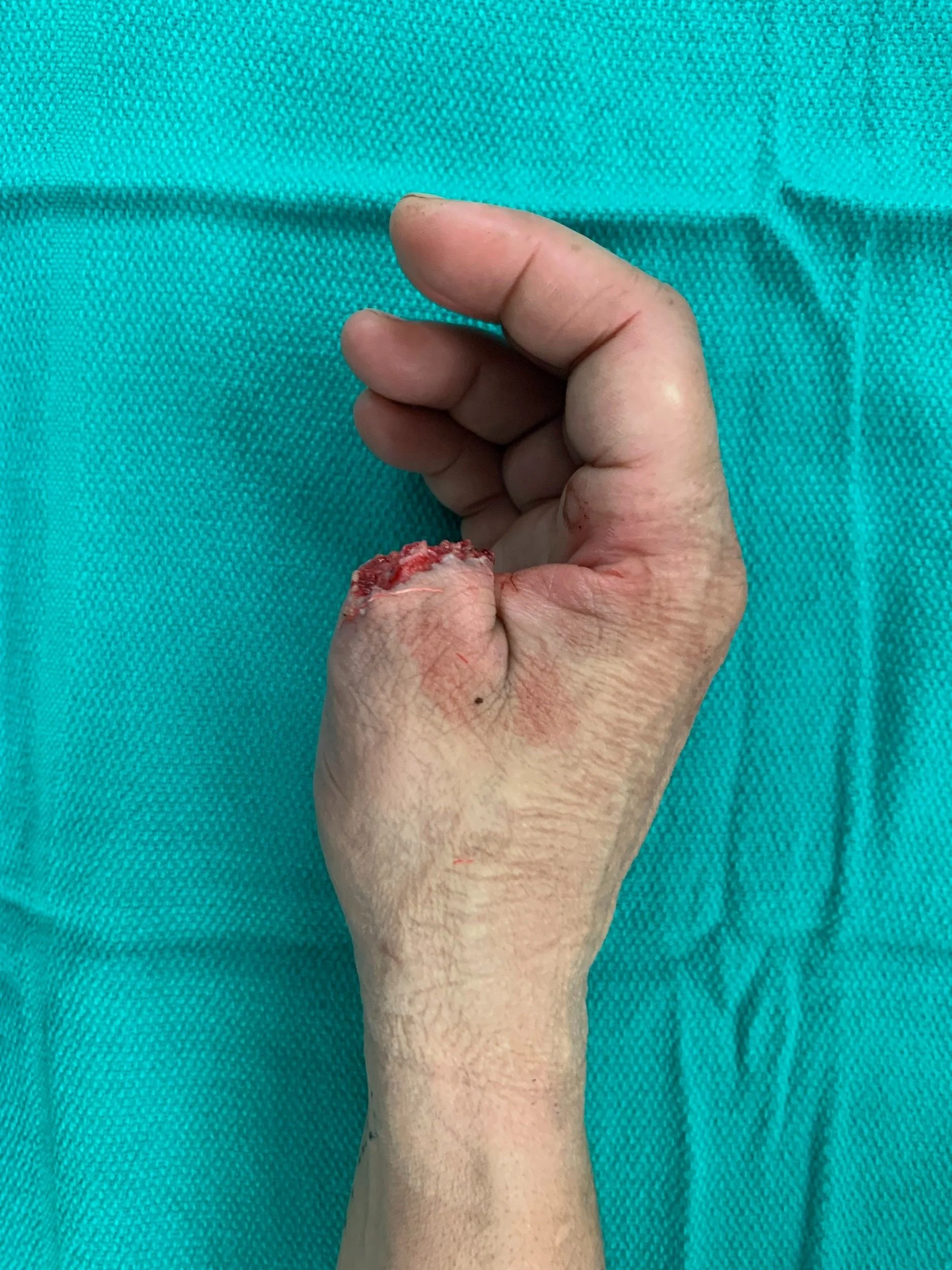 Pre-Op Thumb Replant 1.jpg