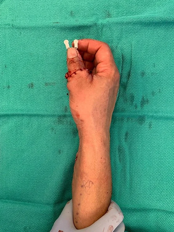 Immediate+Post-Op+Thumb+Replant.jpg