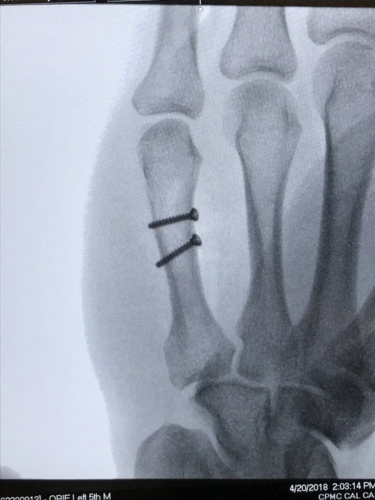 X-Ray of lag screw fixation