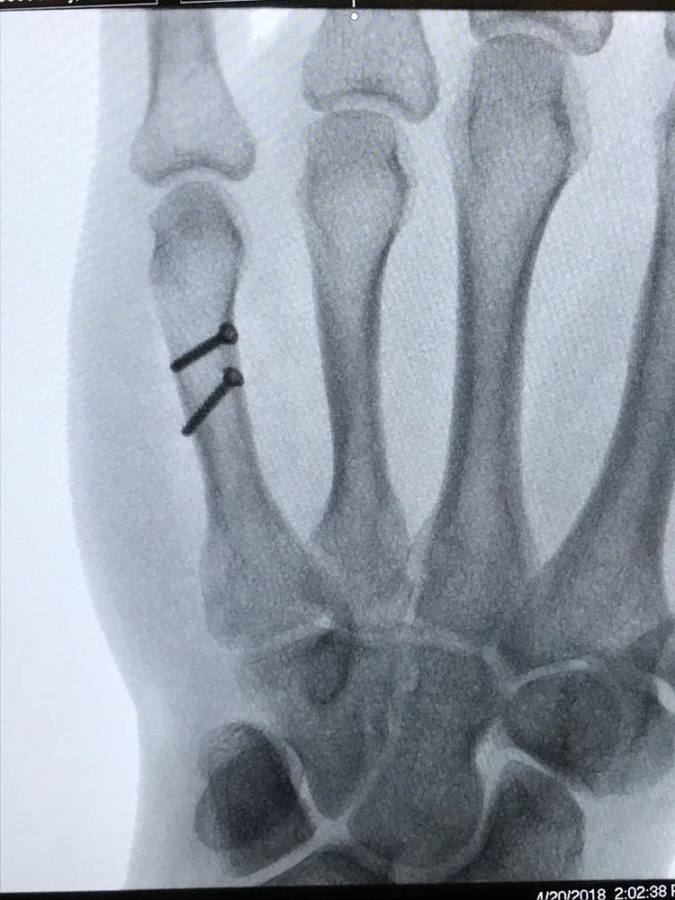Spiral oblique metacarpal fracture lag screw fixation