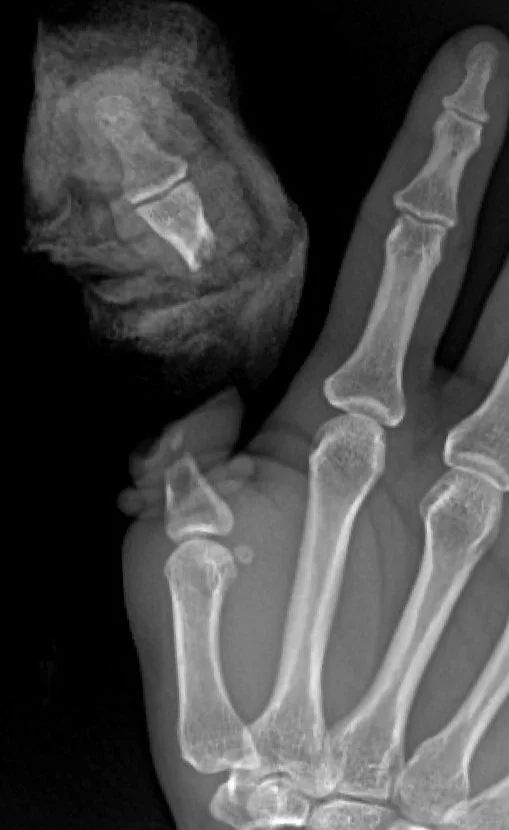 Thumb Replant X-Ray.jpg
