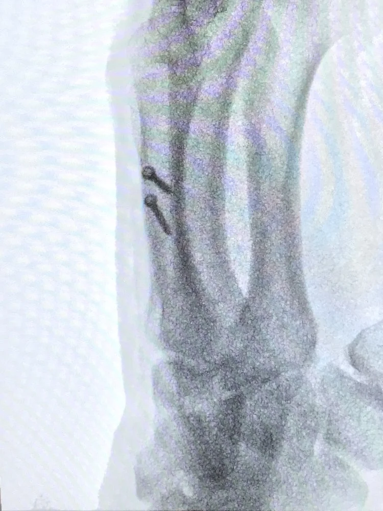 Spiral oblique metacarpal fracture lag screw fixation