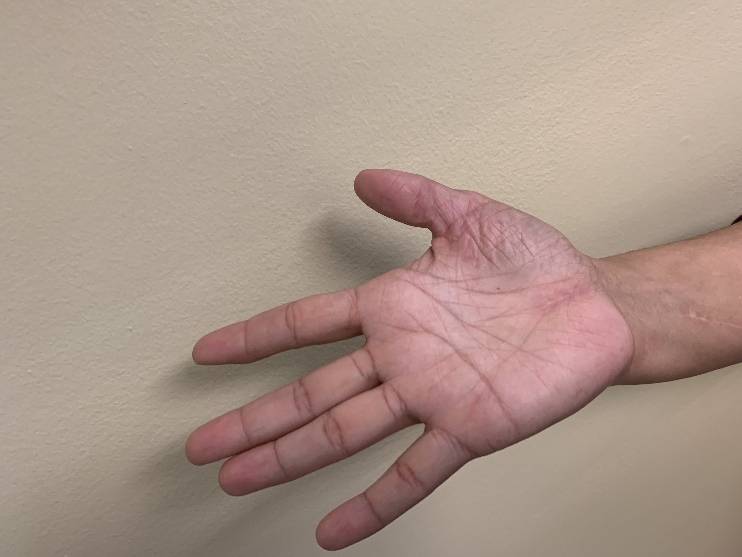 Thumb Replant Follow-Up 1.JPG