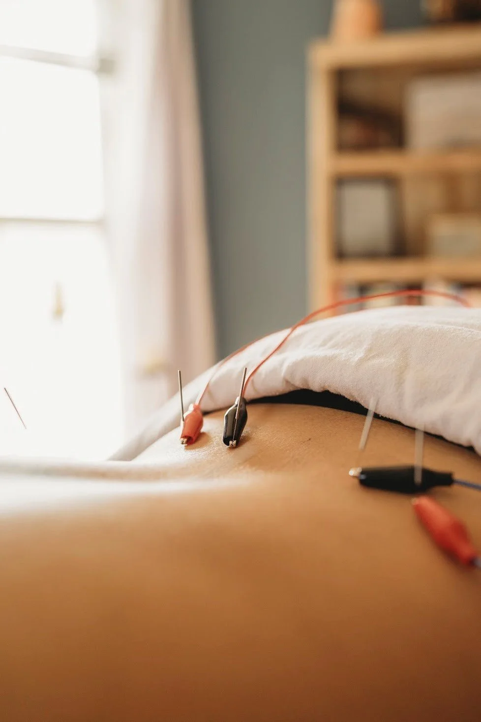 acupuncurist in Corning NY applying electroacupuncture techniques to a patient for lower back pain issue.