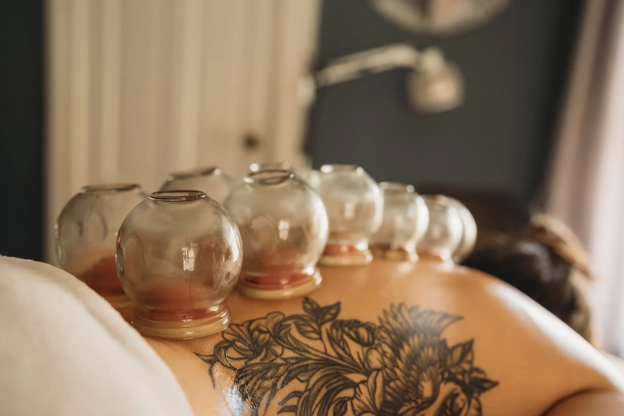 acupuncturist in Corning NY applying a series of traditional glass fire cupping cups to a patients back for muscle pain relief