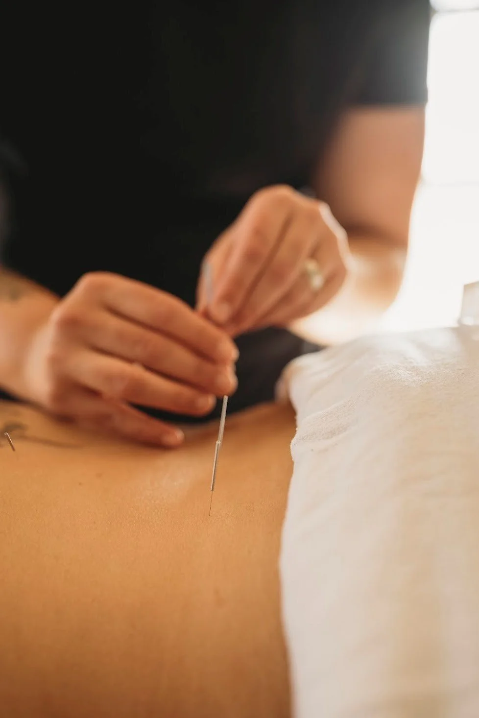 acupuncturists in Corning NY applying acupuncture needles to patients back