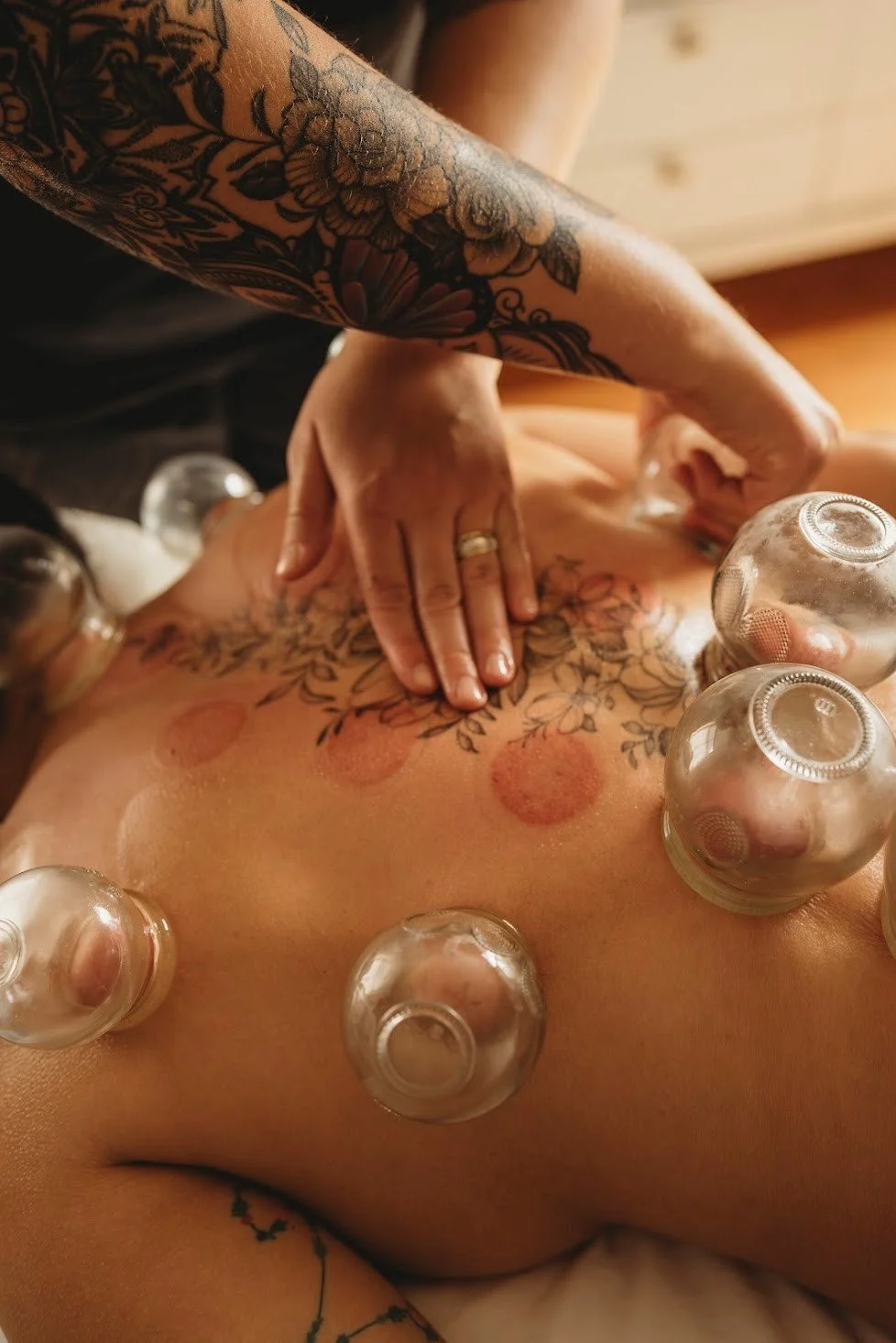 acupuncturist in Corning NY applying traditional glass fire cupping cups to a patients back for muscle pain relief