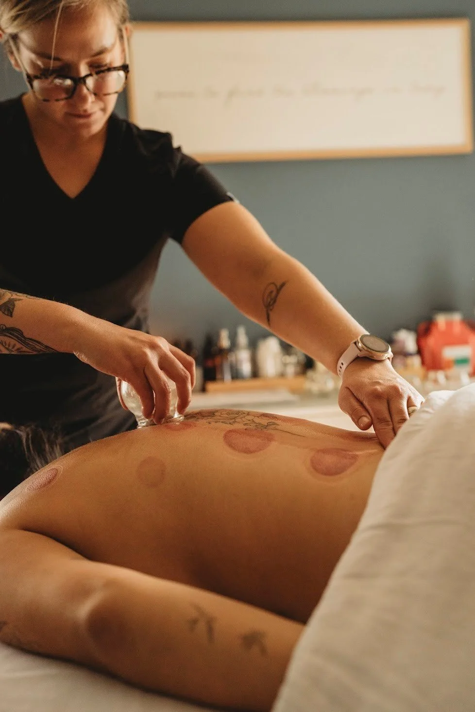Dr. Samantha Burris working a traditional glass cupping cup for a patient at Essence Healing Acupuncture in Corning NY