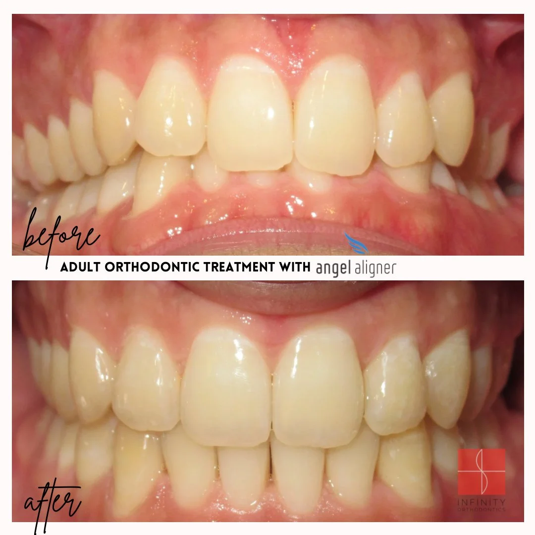 Twelve months of treatment with @angelaligners = a very happy patient! 

His deep bite was starting to cause damage to the lower front teeth he disliked the crowding - nothing aligners and some discipline can&rsquo;t accomplish 🪄✨

 #smileforinfinit