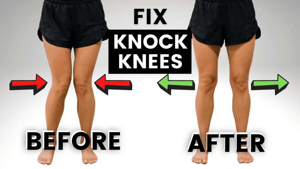 Zoom class Knock knees — Align Pain Solutions Posture alignment